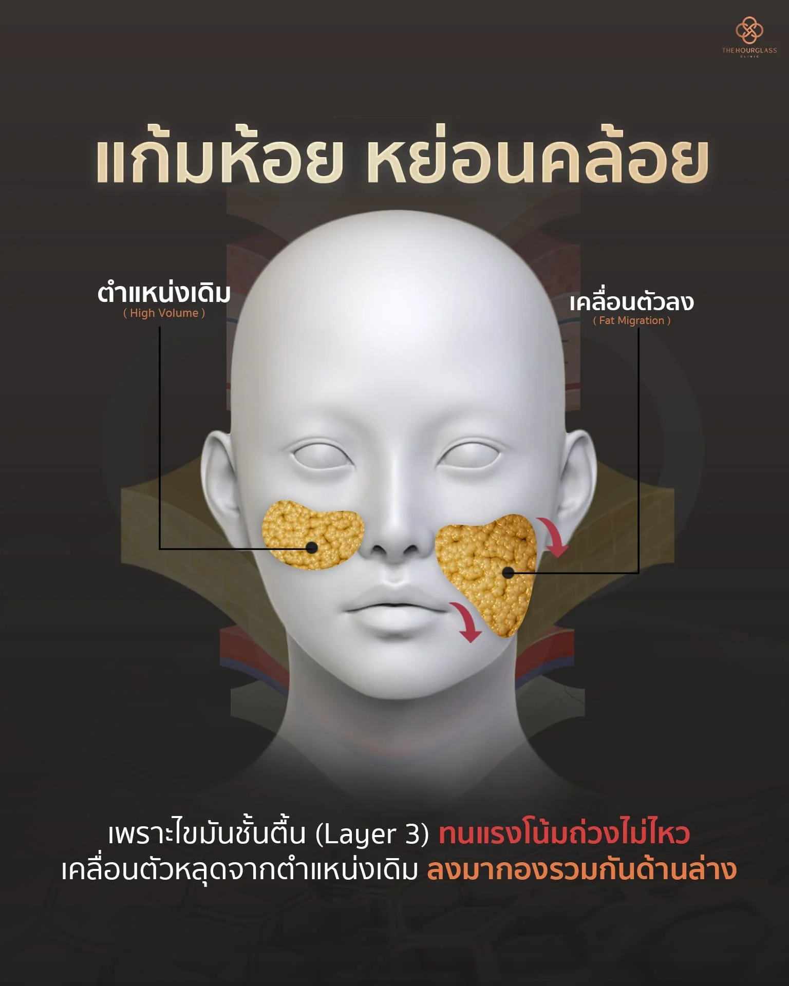 กราฟิกแสดงปัญหาแก้มห้อยจากการที่ไขมันชั้นตื้น (Layer 3) ทนแรงโน้มถ่วงไม่ไหวและเคลื่อนตัว (Fat Migration) ลงมาสะสมที่บริเวณกระพุ้งแก้มล่าง แก้ไขได้ด้วยการร้อยไหมเทคนิค THC Lock ที่ The Hourglass Clinic