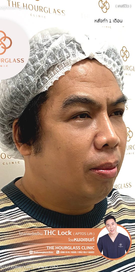 รีวิว ร้อยไหม APTOS หลังทำ 1 เดือน หมอเซนท์​ The Hourglass Clinic