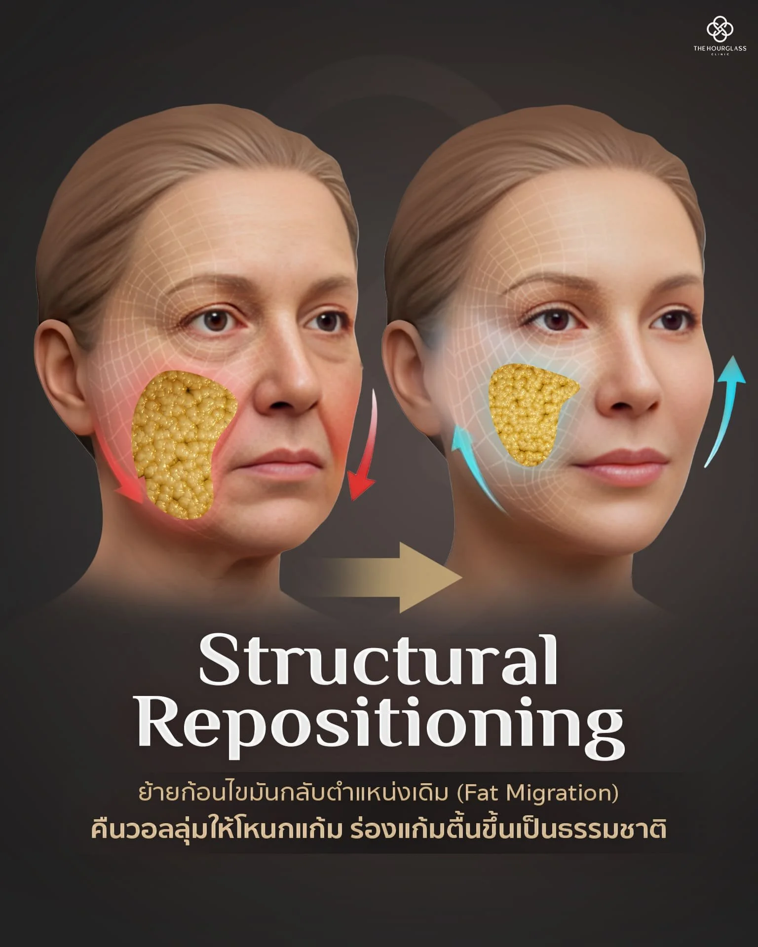 อินโฟกราฟิกแสดงผลลัพธ์ Structural Repositioning จากการร้อยไหม Signature Lift ที่ย้ายตำแหน่งก้อนไขมันที่หย่อนคล้อยกลับสู่ที่เดิม ทำให้หน้าอิ่มฟูและดูเด็กอย่างเป็นธรรมชาติโดยไม่ตึงแข็ง