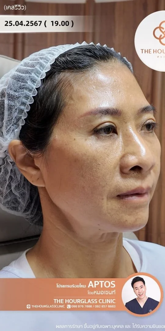 ภาพรีวิว ก่อนการร้อยไหมโปรแกรม APTOS Lift (Before) แสดงให้เห็นปัญหาความหย่อนคล้อยบริเวณแก้มและกรอบหน้าที่ไม่คมชัดของผู้รับบริการจริงที่ The Hourglass Clinic