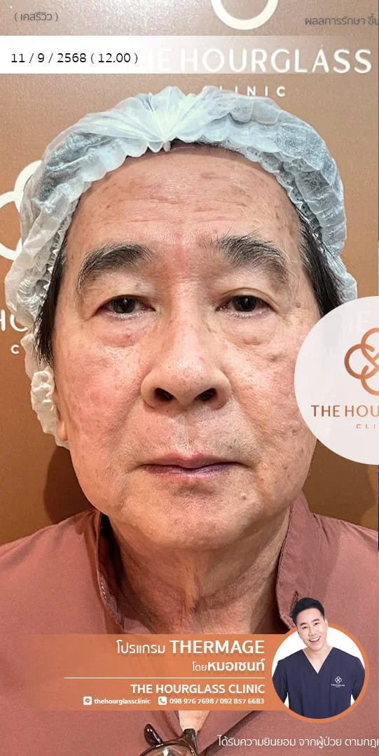 รีวิวก่อนทำ Thermage FLX เพื่อแก้ไขปัญหาผิวหย่อนคล้อยและกรอบหน้าไม่ชัดเจน เคสหมอเซนท์ The Hourglass Clinic  แสดงลักษณะผิวที่ขาดความกระชับก่อนรับบริการ