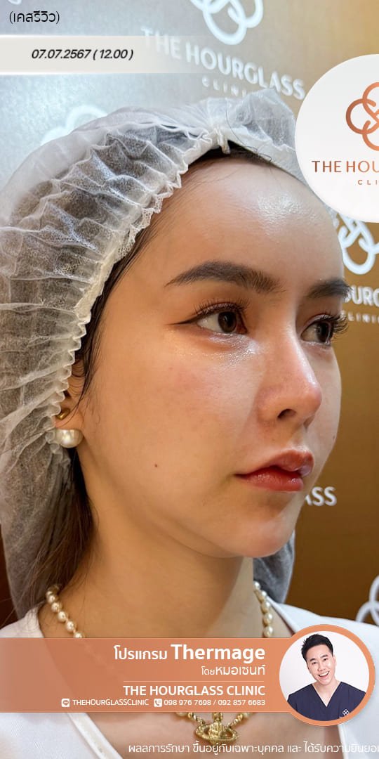 รีวิวก่อนทำ Thermage FLX เพื่อแก้ไขปัญหาผิวหย่อนคล้อยและกรอบหน้าไม่ชัดเจน เคสหมอเซนท์ The Hourglass Clinic  แสดงลักษณะผิวที่ขาดความกระชับก่อนรับบริการ