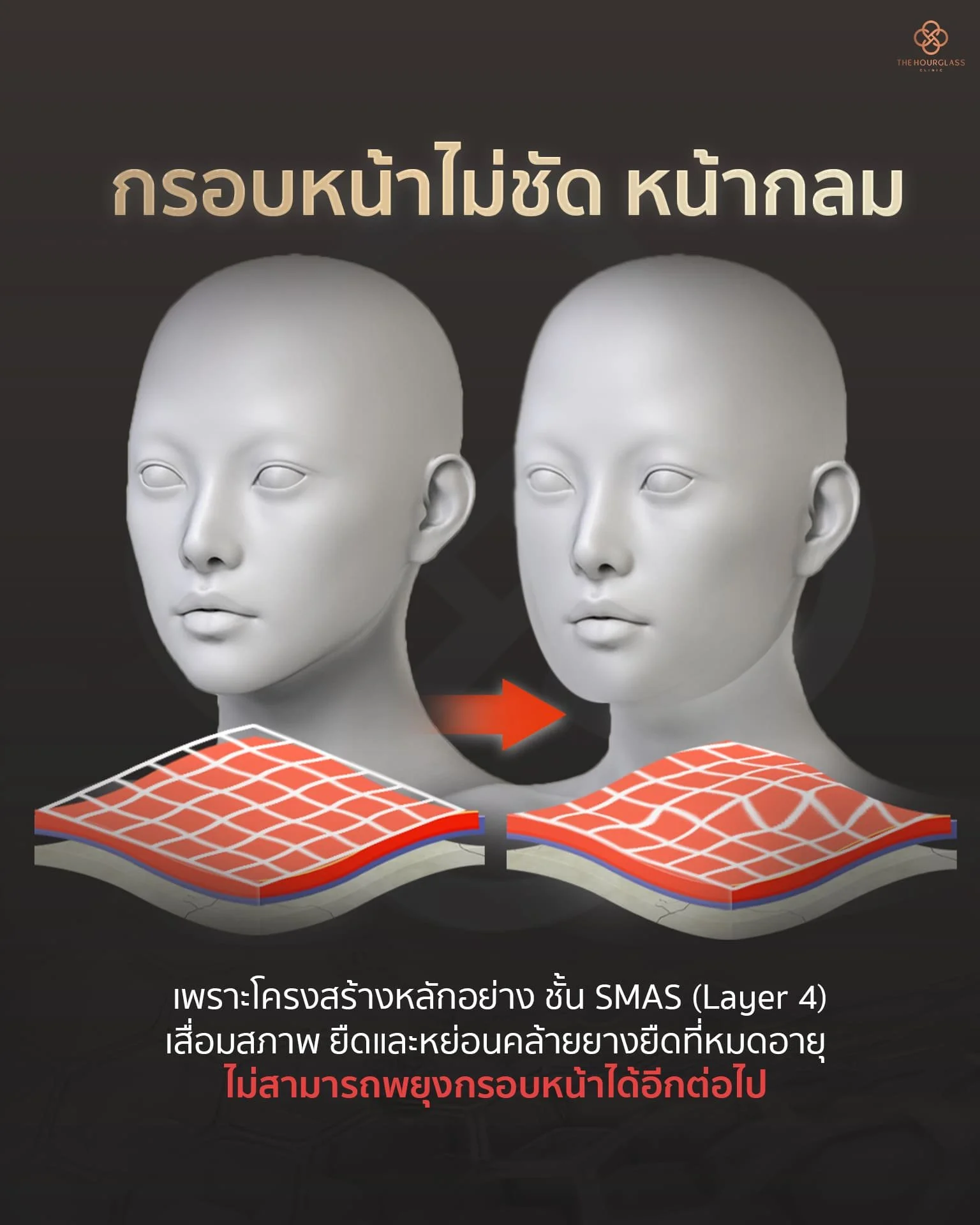 กราฟิกเปรียบเทียบกรอบหน้าไม่ชัดที่เกิดจากชั้นพังผืด SMAS (Layer 4) เสื่อมสภาพและยืดย้วยคล้ายยางยืดหมดอายุ ทำให้ไม่สามารถพยุงรูปหน้าได้ เตรียมรับการล็อคหน้าด้วยเทคนิค THC Lock ลึกถึงชั้น SMAS