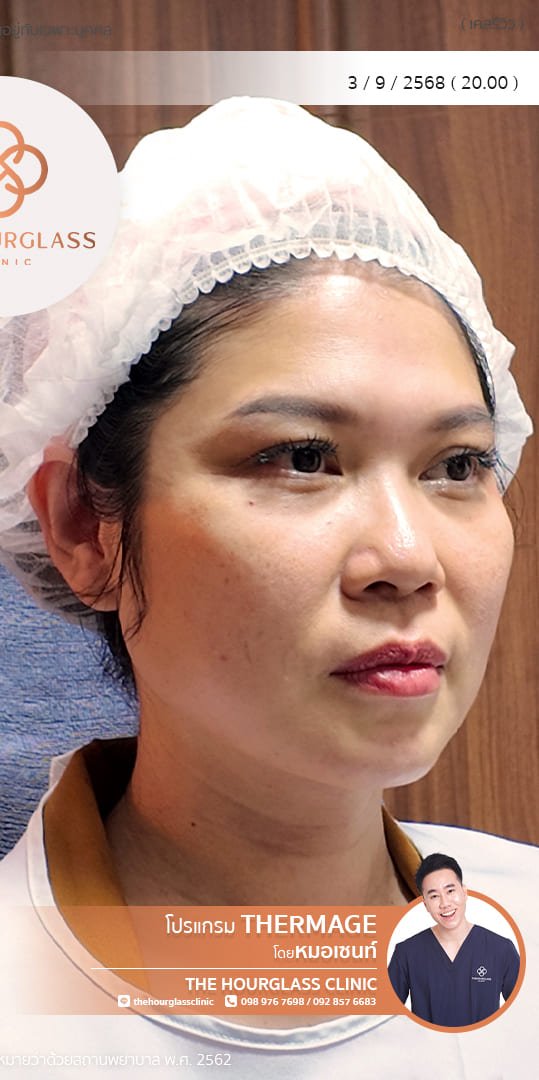 ผลลัพธ์หลังทำทันที Thermage FLX โดยหมอเซนท์ The Hourglass Clinic  แสดงใบหน้าที่ยกกระชับ กรอบหน้าที่ชัดมากขึ้น รอยพับร่องแก้ม ร่องน้ำหมากที่จางลงอย่างเห็นได้ชัด