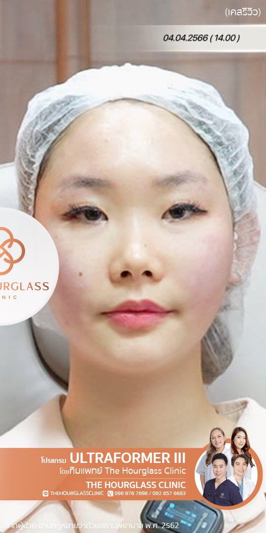 รีวิวหลังทำ Ultraformer III ทันที ช่วยยกกระชับกรอบหน้า ปรับหน้าเรียว V-Shape และลดความหย่อนคล้อย ที่ The Hourglass Clinic