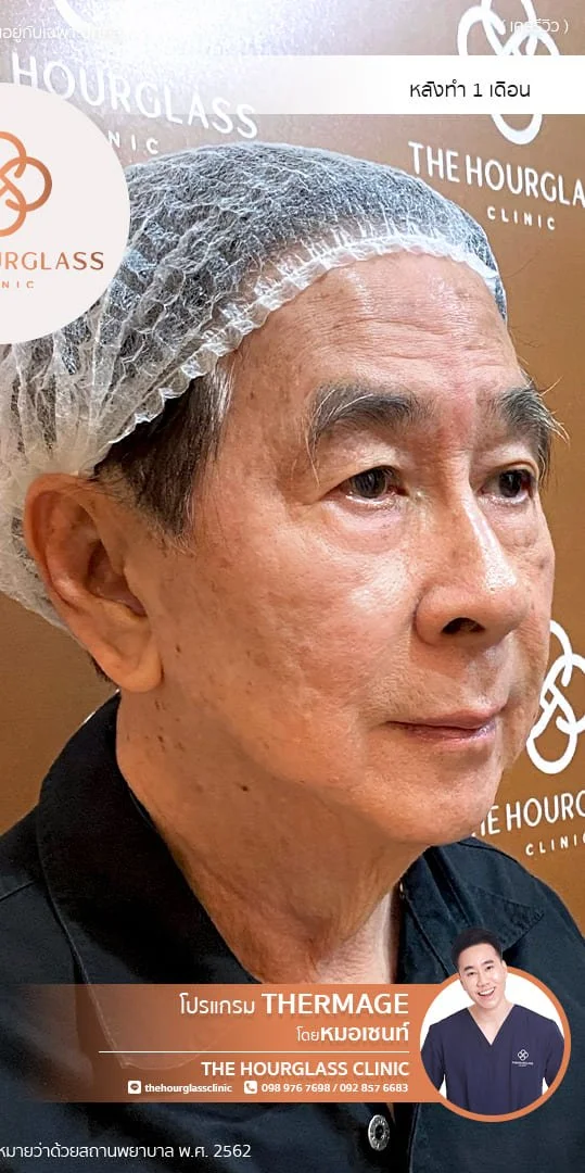 ผลลัพธ์หลังทำ 1 เดือน Thermage FLX  โดยหมอเซนท์ The Hourglass Clinic  แสดงใบหน้าที่ยกกระชับ กรอบหน้าคมชัด และผิวแน่นอิ่มฟูขึ้นอย่างเห็นได้ชัด