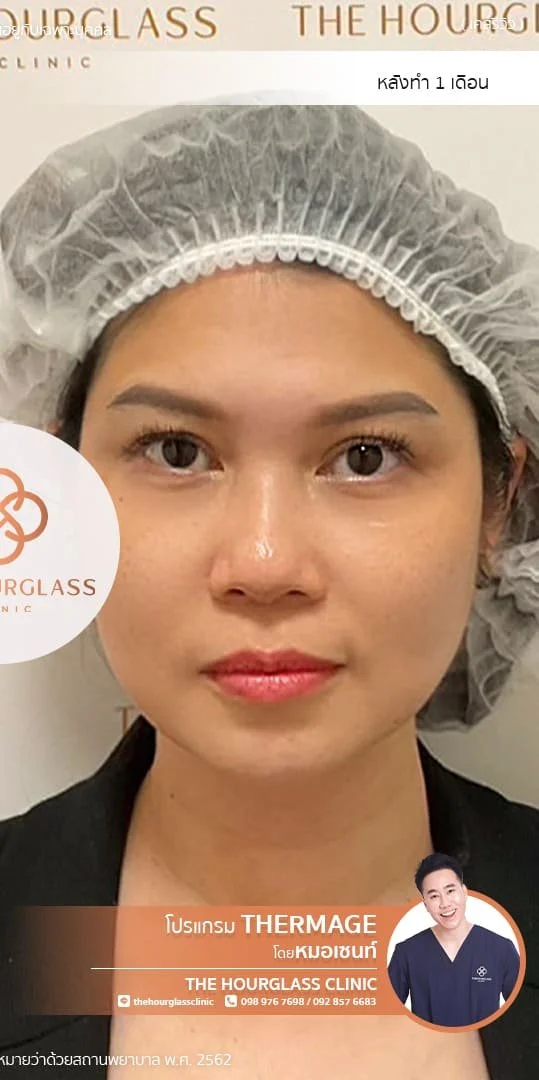ผลลัพธ์หลังทำ 1 เดือน Thermage FLX โดยหมอเซนท์ The Hourglass Clinic  แสดงใบหน้าที่ยกกระชับ กรอบหน้าที่ชัดมากขึ้น รอยพับร่องแก้ม ร่องน้ำหมาก ร่องแก้ม ที่จางลงอย่างเห็นได้ชัด