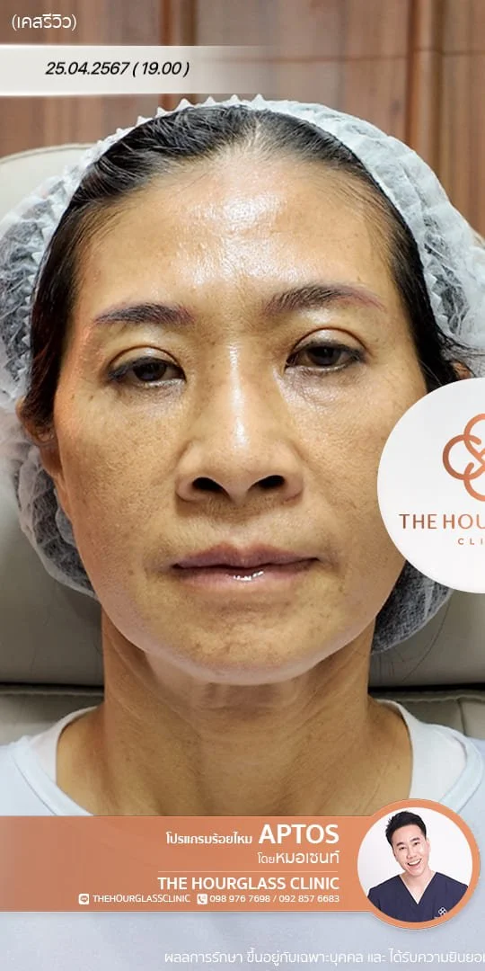 ภาพรีวิว ก่อนการร้อยไหมโปรแกรม APTOS Lift (Before) แสดงให้เห็นปัญหาความหย่อนคล้อยบริเวณแก้มและกรอบหน้าที่ไม่คมชัดของผู้รับบริการจริงที่ The Hourglass Clinic