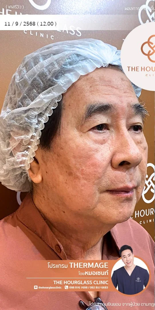รีวิวก่อนทำ Thermage FLX เพื่อแก้ไขปัญหาผิวหย่อนคล้อยและกรอบหน้าไม่ชัดเจน เคสหมอเซนท์ The Hourglass Clinic  แสดงลักษณะผิวที่ขาดความกระชับก่อนรับบริการ