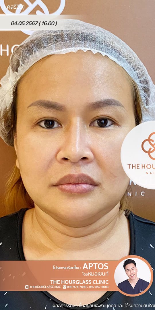 ภาพรีวิว ก่อนการร้อยไหมโปรแกรม APTOS Lift (Before) แสดงให้เห็นปัญหาความหย่อนคล้อยบริเวณแก้มและกรอบหน้าที่ไม่คมชัดของผู้รับบริการจริงที่ The Hourglass Clinic