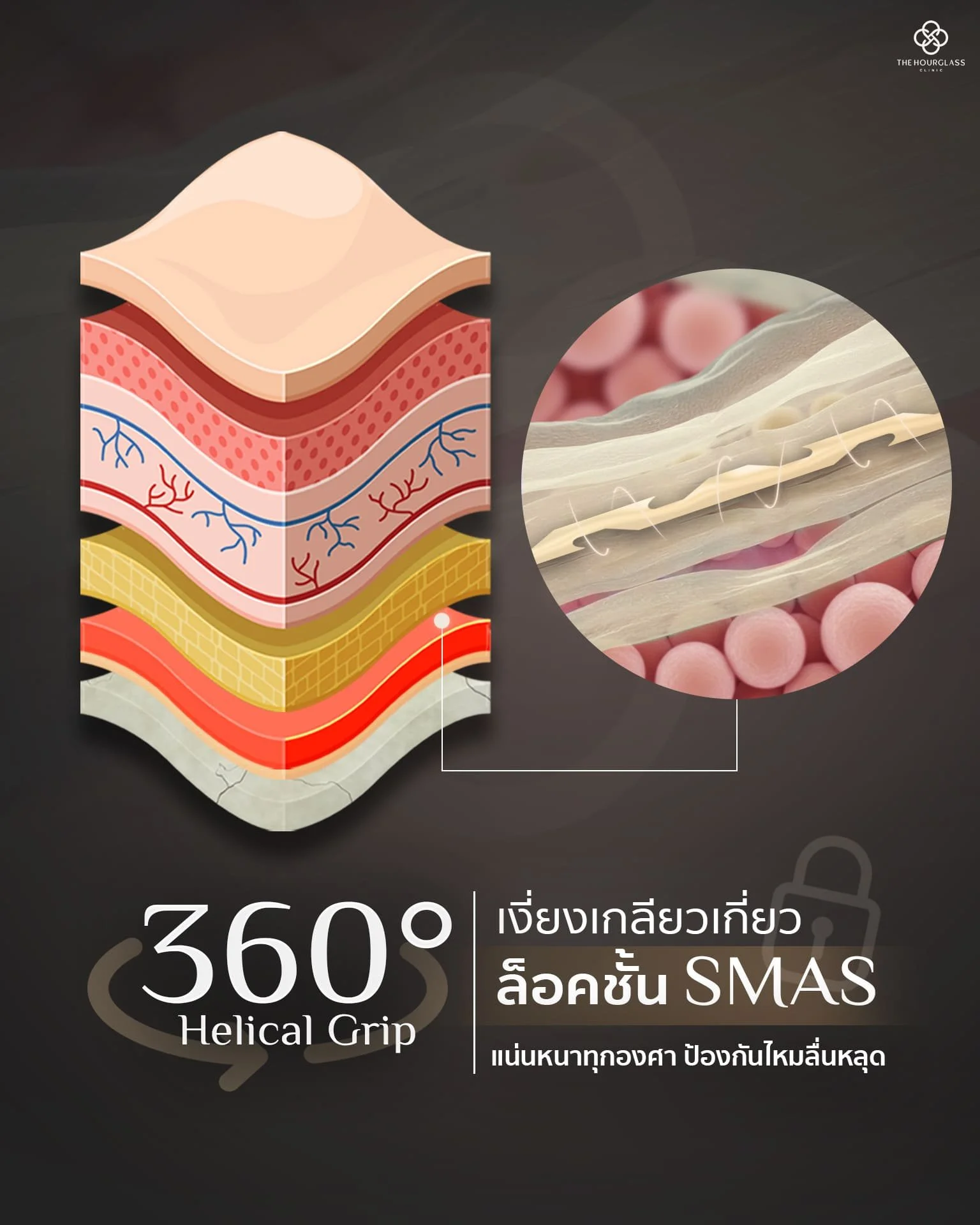 ภาพจำลองการทำงานของไหมหล่อ 360 องศา (Signature Lift) ที่ใช้เทคนิค Helical Grip เกี่ยวล็อคกับชั้นพังผืด SMAS (Layer 4) อย่างมั่นคงทุกทิศทางด้วยเทคนิค THC Lock