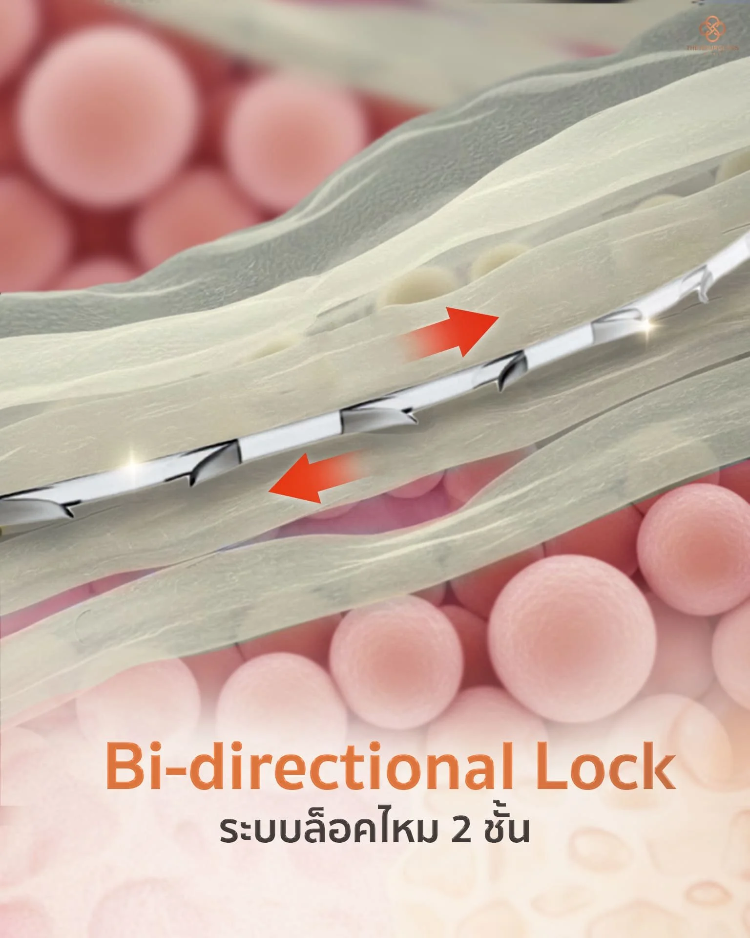 ภาพขยายระบบ Bi-directional Lock ของไหม THC Lock แสดงเงี่ยงไหมที่ล็อคเนื้อเยื่อสองทิศทางอย่างแน่นหนา ช่วยยึดเกาะชั้นพังผืดและไขมันให้ยกตึงอย่างมั่นคง ป้องกันการไหลย้อนกลับของผิว