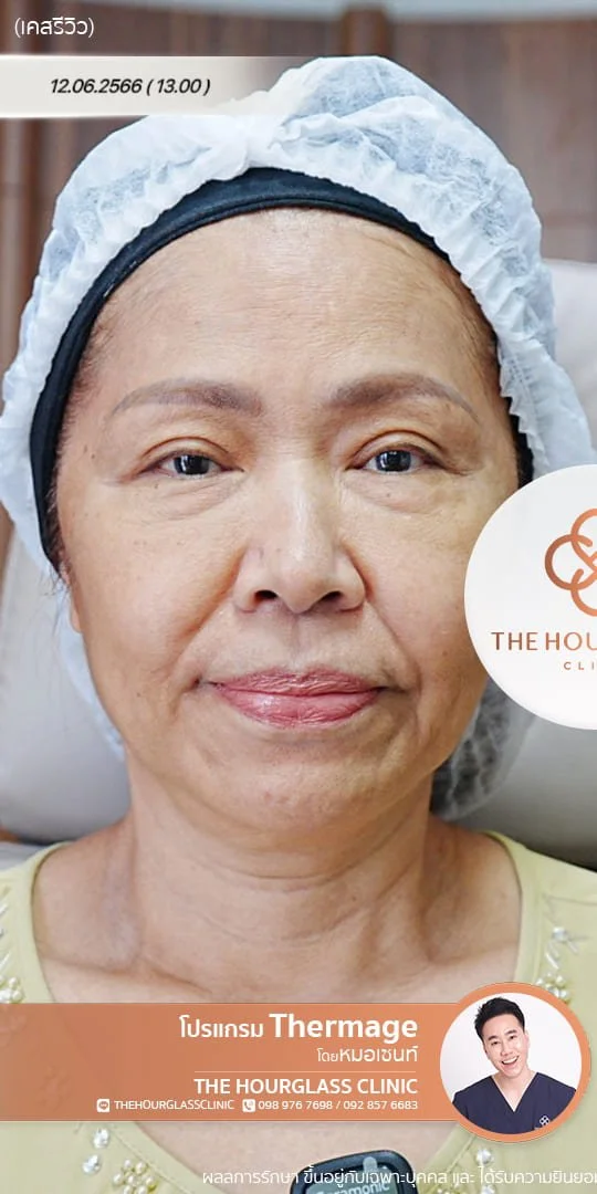 รีวิวก่อนทำ Thermage FLX เพื่อแก้ไขปัญหาผิวหย่อนคล้อยและกรอบหน้าไม่ชัดเจน เคสหมอเซนท์ The Hourglass Clinic  แสดงลักษณะผิวที่ขาดความกระชับก่อนรับบริการ