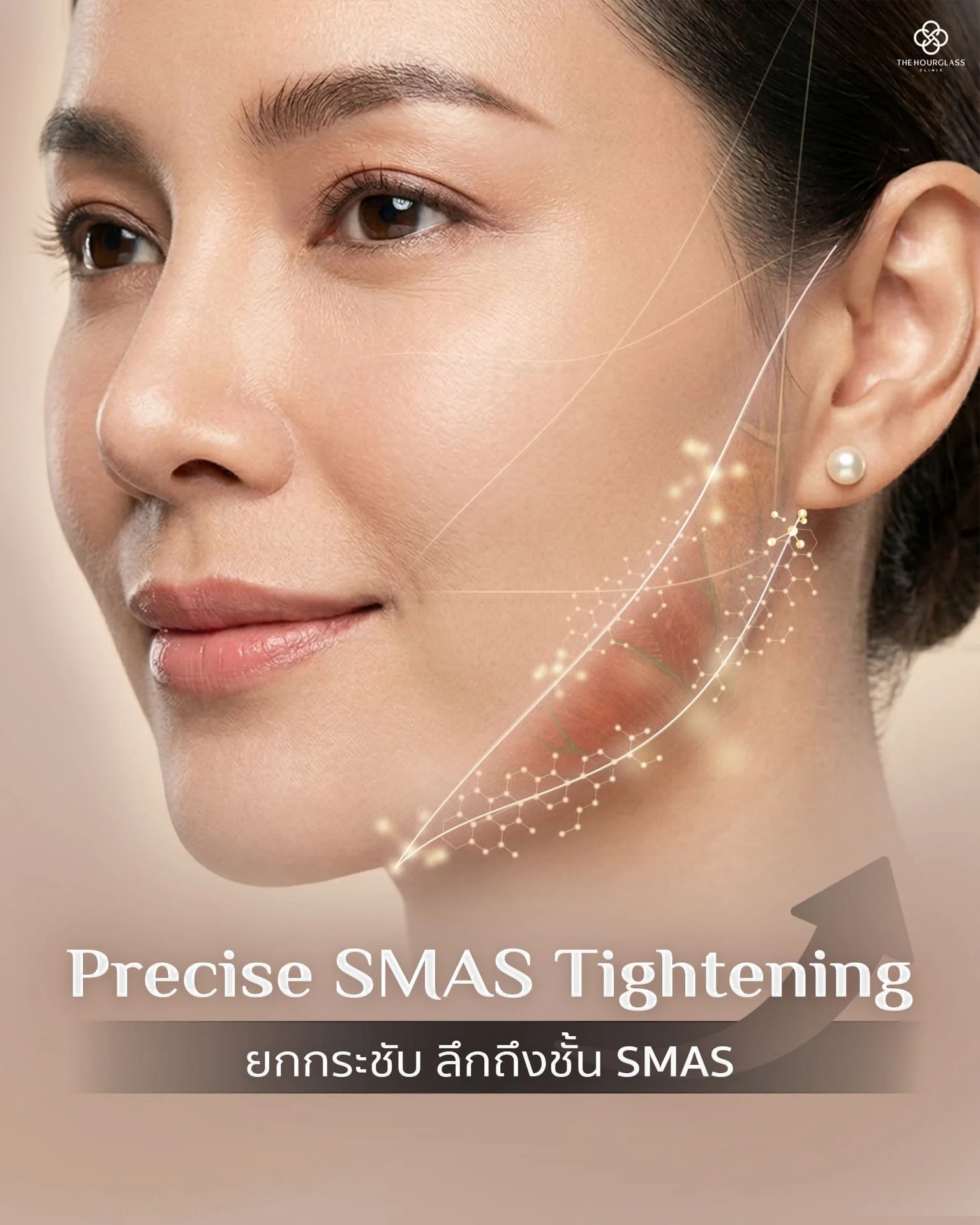 กราฟิกแสดงการทำงานของไหม V-Lift ในการยกกระชับระดับ SMAS เพื่อคืนความแน่นกระชับให้ผิวที่หย่อนคล้อยกลับมาเรียบเนียน