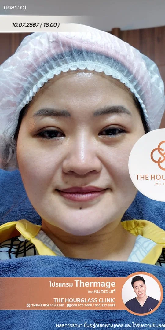 รีวิวก่อนทำ Thermage FLX เพื่อแก้ไขปัญหาผิวหย่อนคล้อยและกรอบหน้าไม่ชัดเจน เคสหมอเซนท์ The Hourglass Clinic  แสดงลักษณะผิวที่ขาดความกระชับก่อนรับบริการ