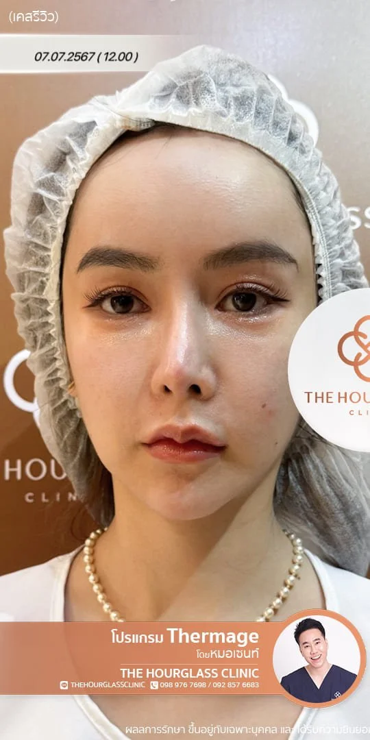 รีวิวก่อนทำ Thermage FLX เพื่อแก้ไขปัญหาผิวหย่อนคล้อยและกรอบหน้าไม่ชัดเจน เคสหมอเซนท์ The Hourglass Clinic  แสดงลักษณะผิวที่ขาดความกระชับก่อนรับบริการ
