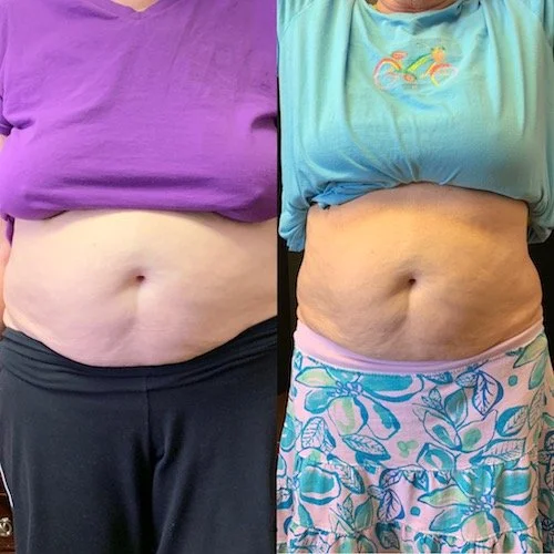 Mei Zen Abdominal Front.JPG