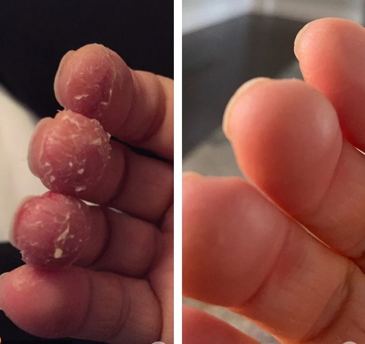 Acupuncture for Psoriasis and Autoimmune Diseases: Christine’s Story 