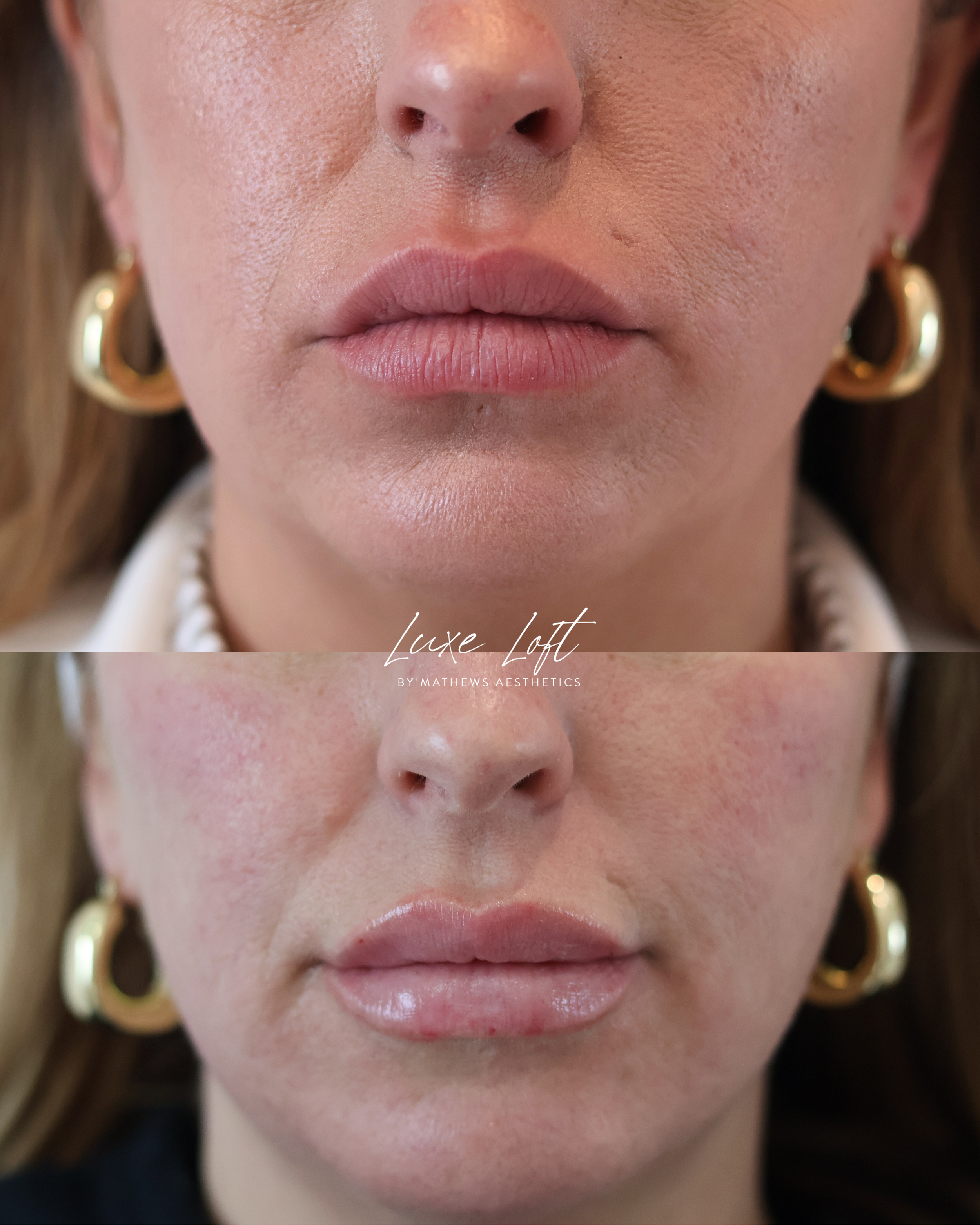Close-up of a woman's face showing before and after cosmetic lip enhancement. Top image shows natural lips, bottom image shows plump, glossy lips with smoother skin around the mouth. Woman has gold hoop earrings and brown hair.