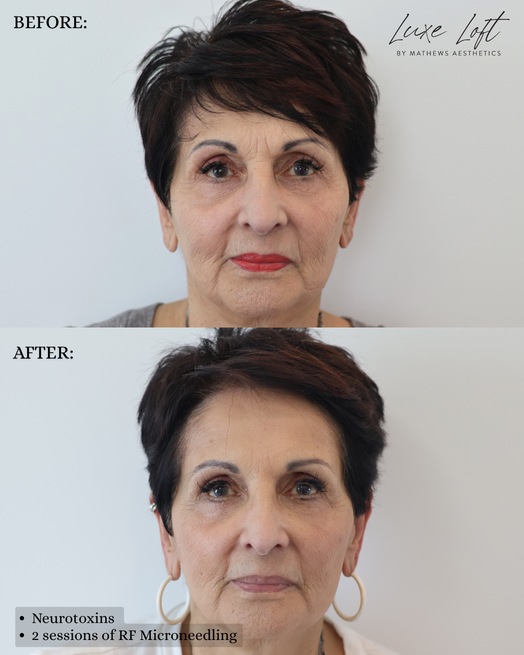 RF Microneedling