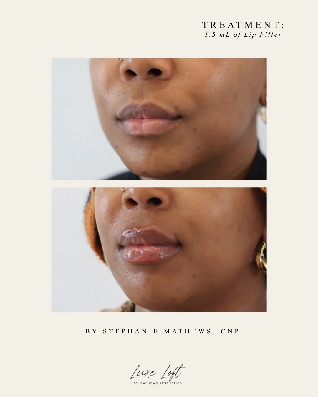 Before and after images showing lip enhancement with lip filler treatment. The top image depicts natural lips, and the bottom image shows fuller, glossy lips after treatment. Text indicates the treatment involved 1.5 mL of lip filler and credits Step
