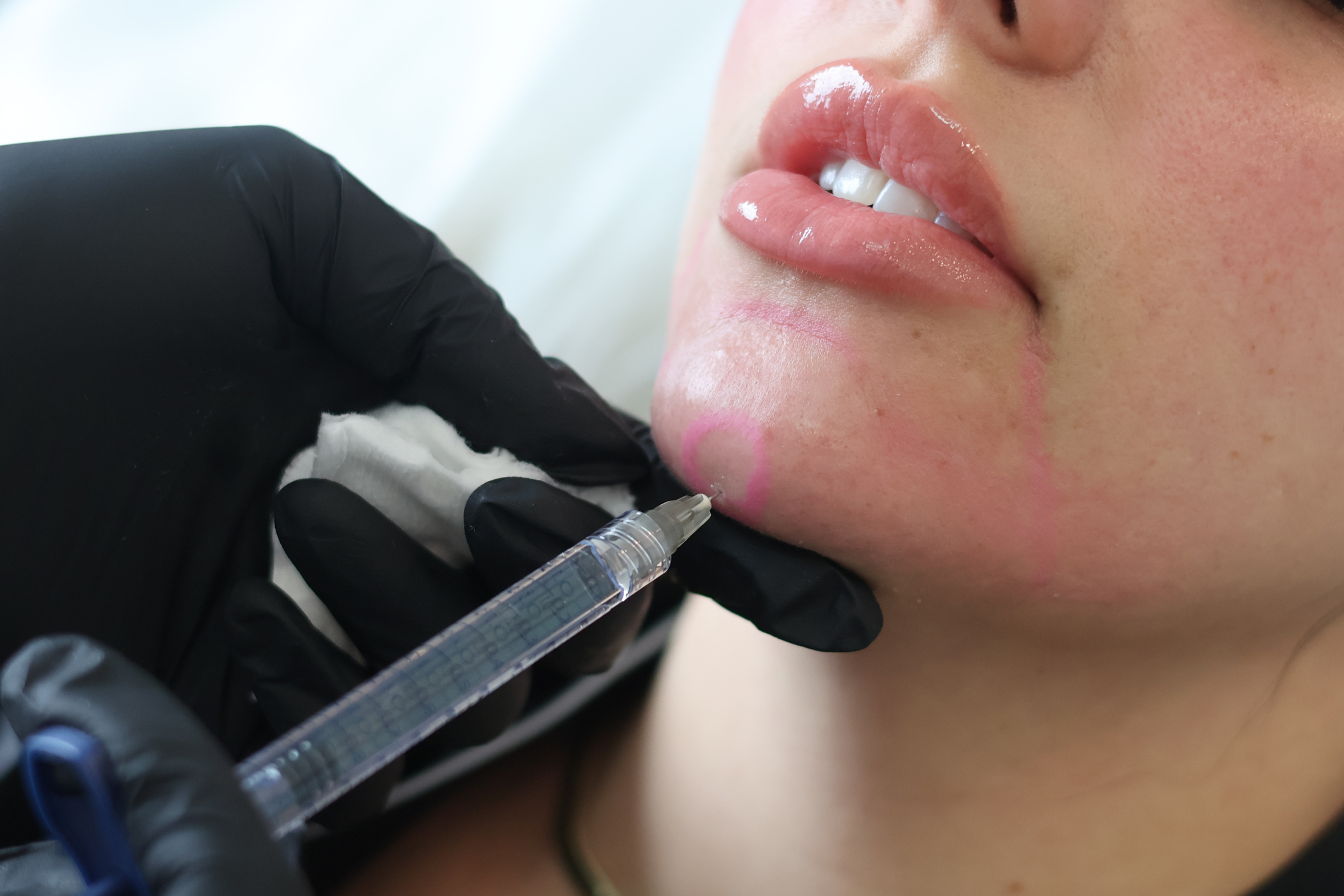 A woman with long hair lying on her back with an acupuncture needle on her nose.