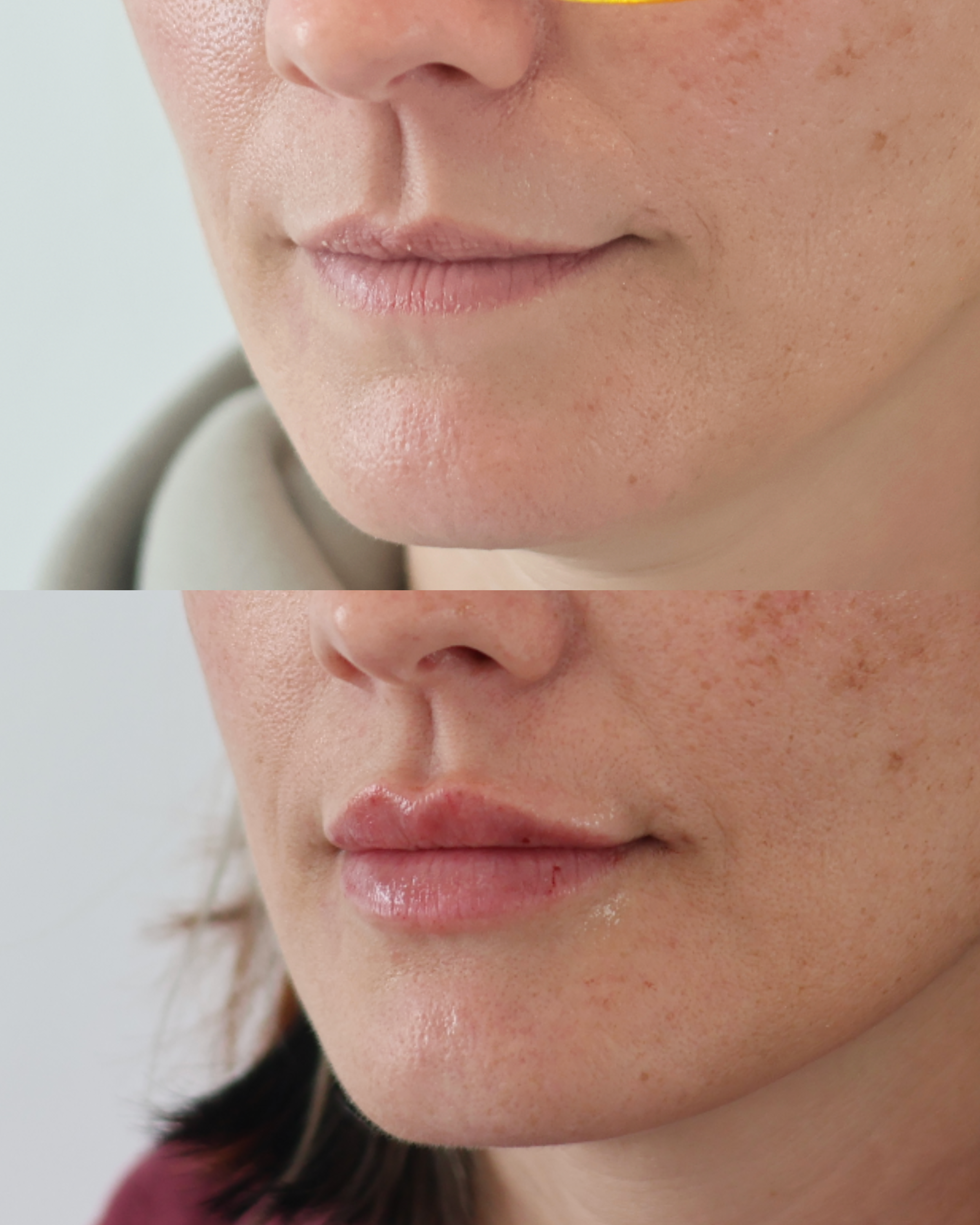 Close-up of a person's lower face with a comparison of before and after lip enhancement.