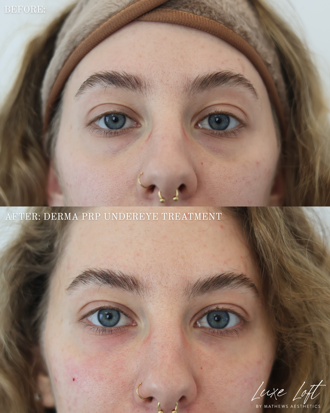 Derma PRP undereye treatment
