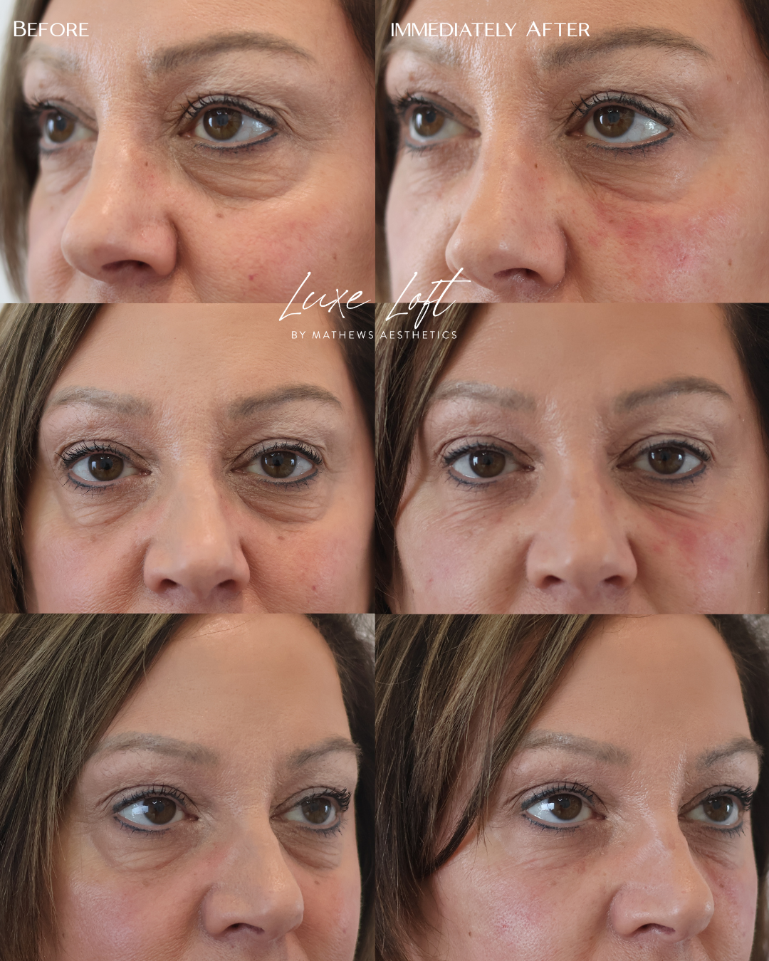 Derma PRP undereye treatment