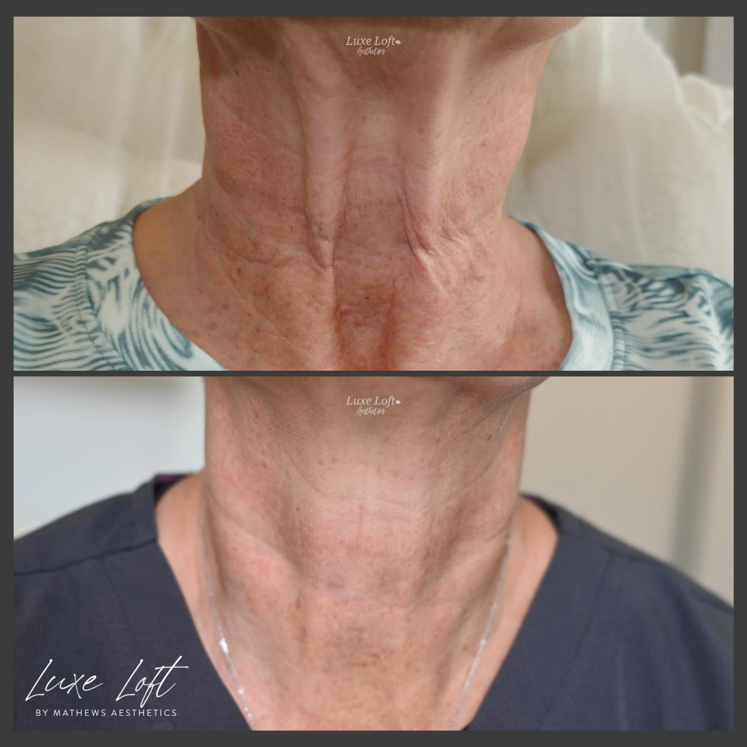 RF Microneedling - Neck