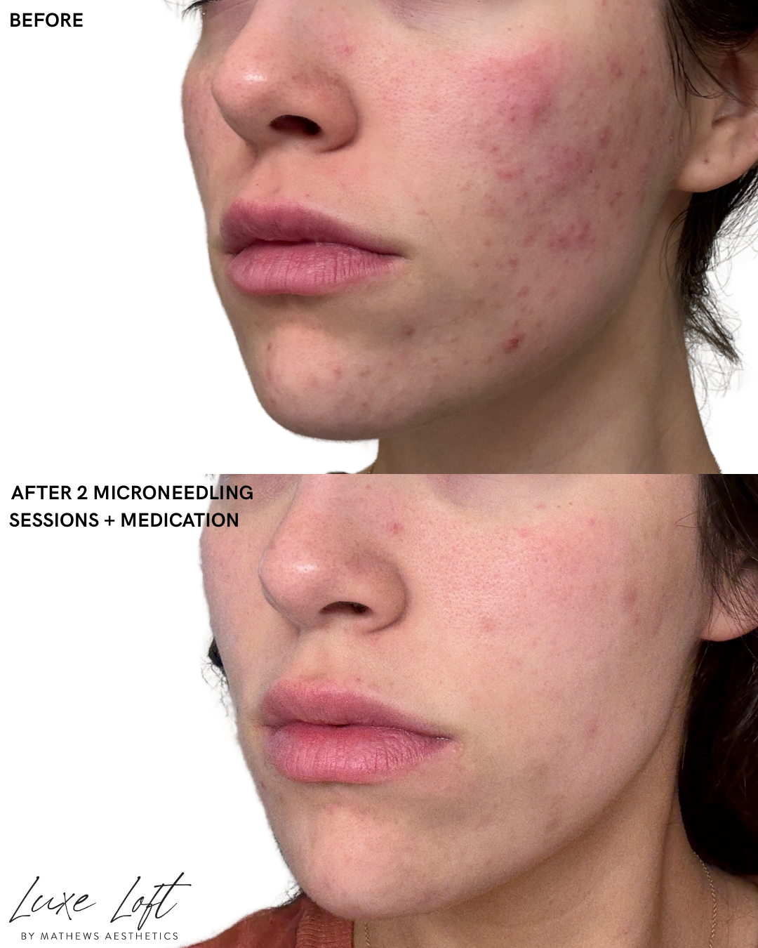 RF Microneedling