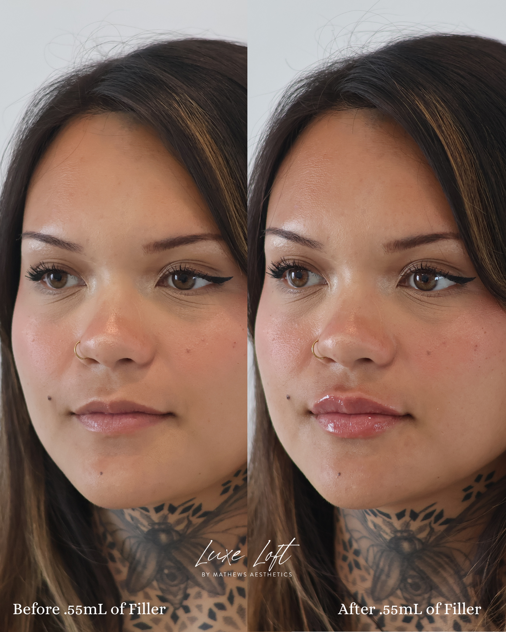 Side-by-side comparison of a woman before and after receiving 0.55 mL of facial filler, showing subtle enhancements in lip volume and facial contours.