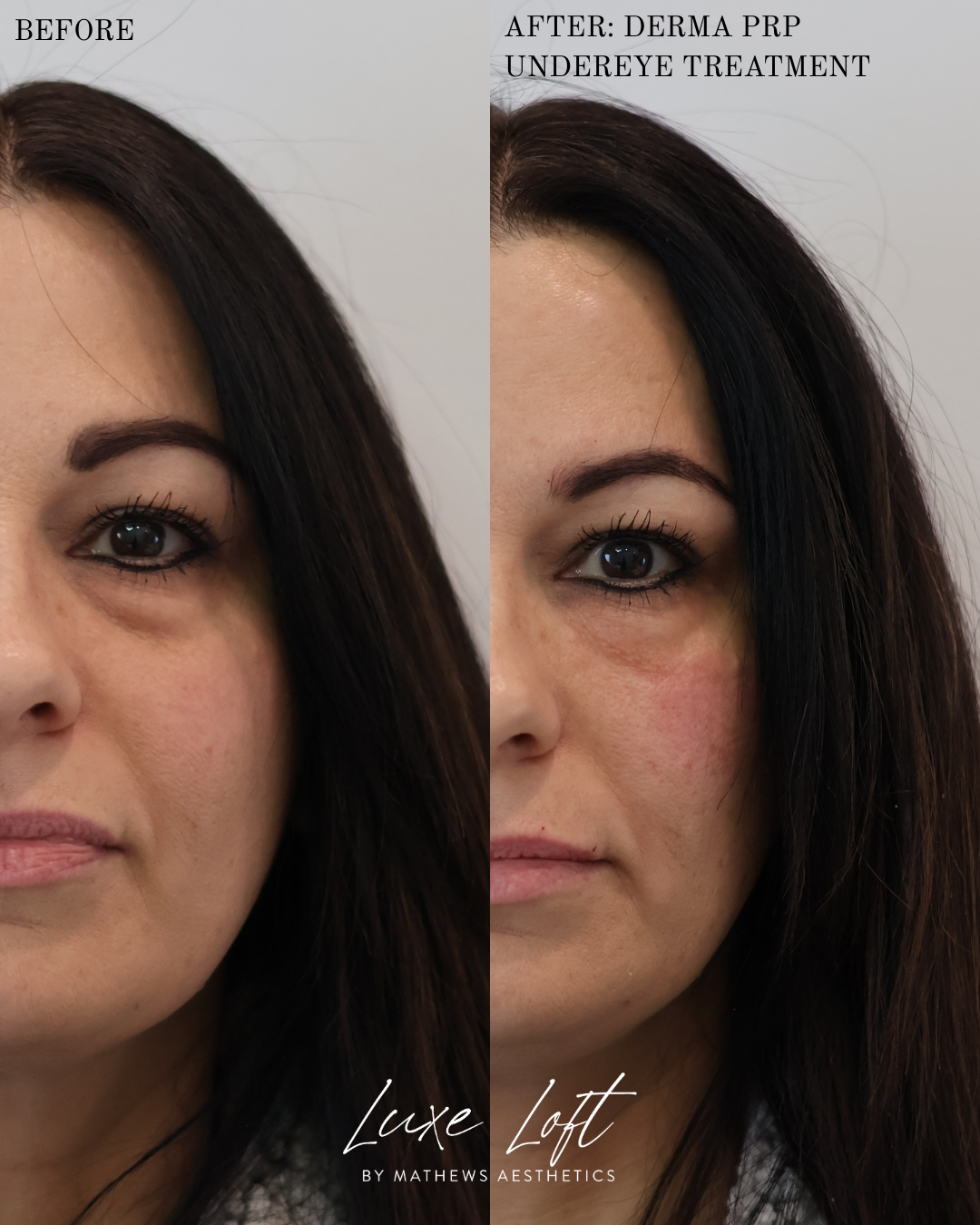 Derma PRP undereye treatment