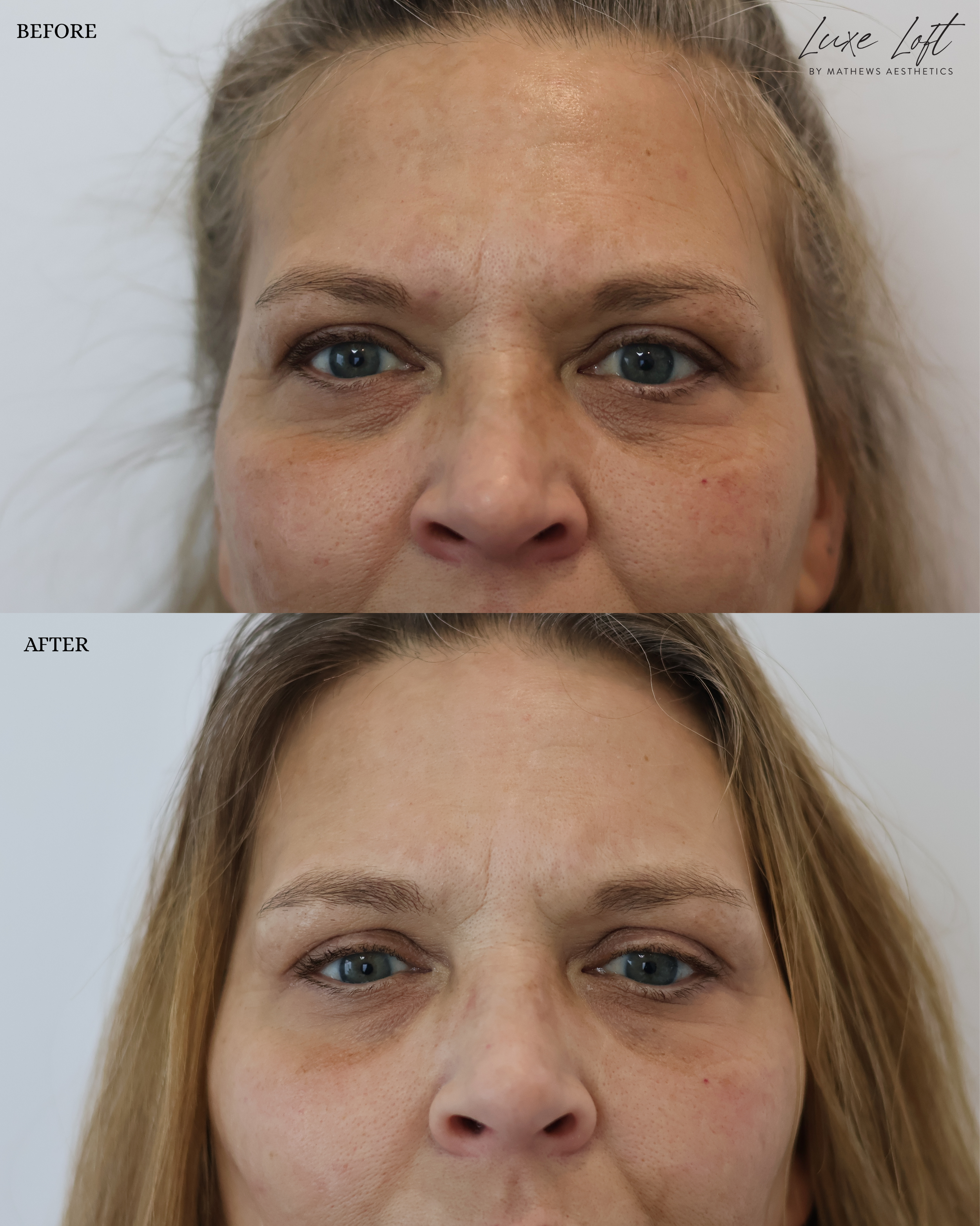 Close-up comparison photos of a woman's face showing a before and after transformation, with smoother skin and reduced under-eye bags in the after image.