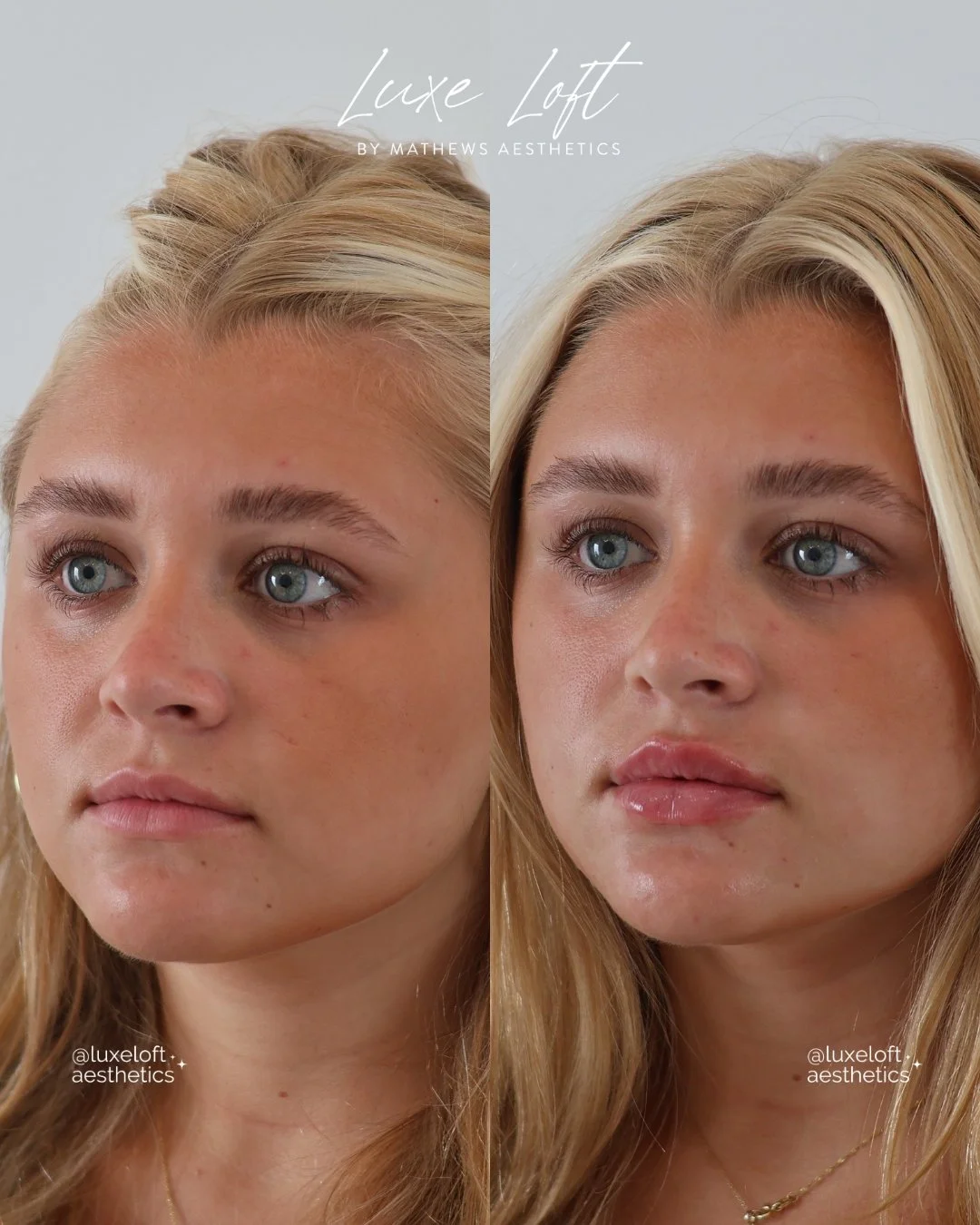 Comparison of a woman's face before and after cosmetic treatment, showing improved skin texture and overall appearance.