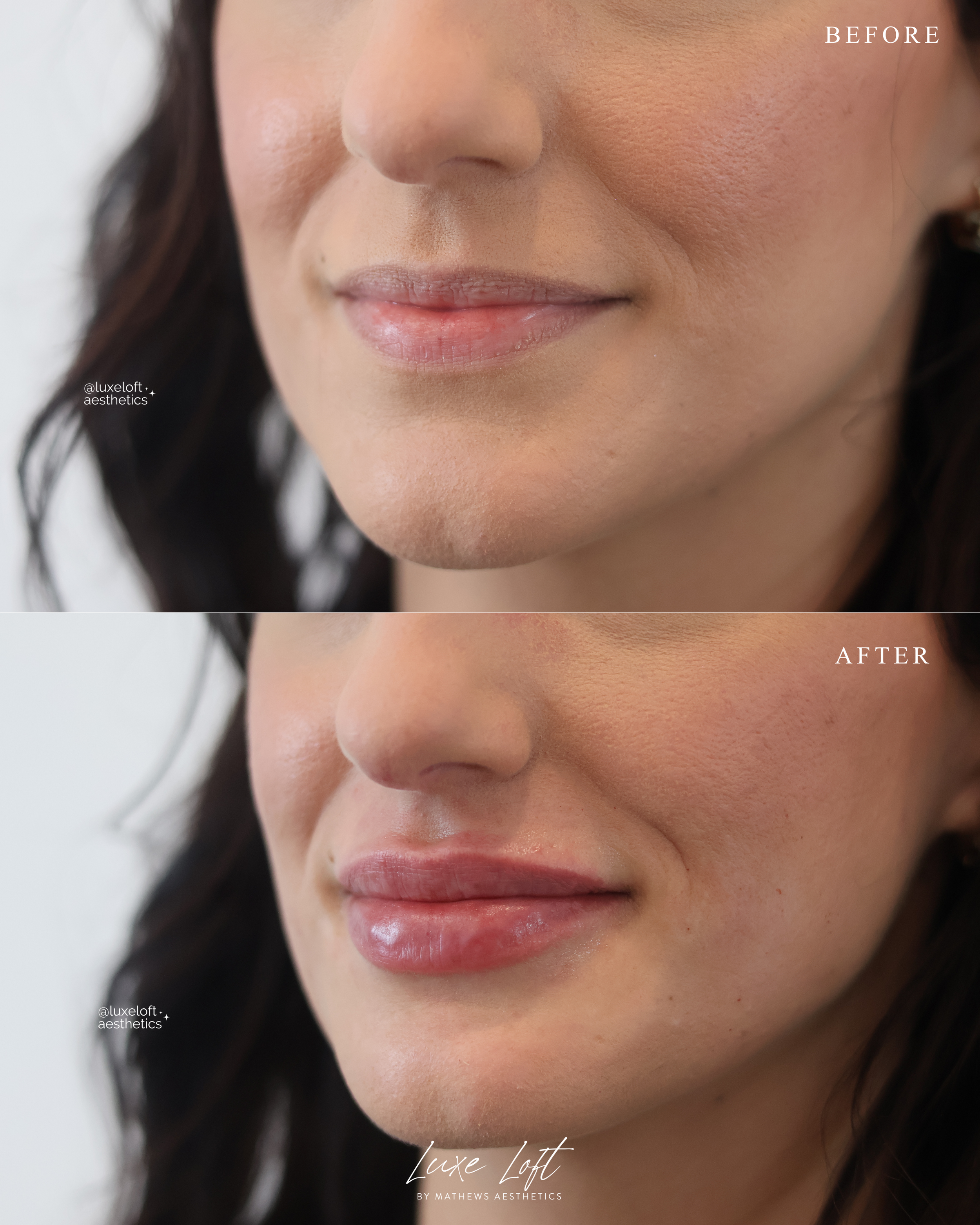 Close-up of a woman's lips before and after a cosmetic improvement, showing smoother, fuller lips in the 'after' image.