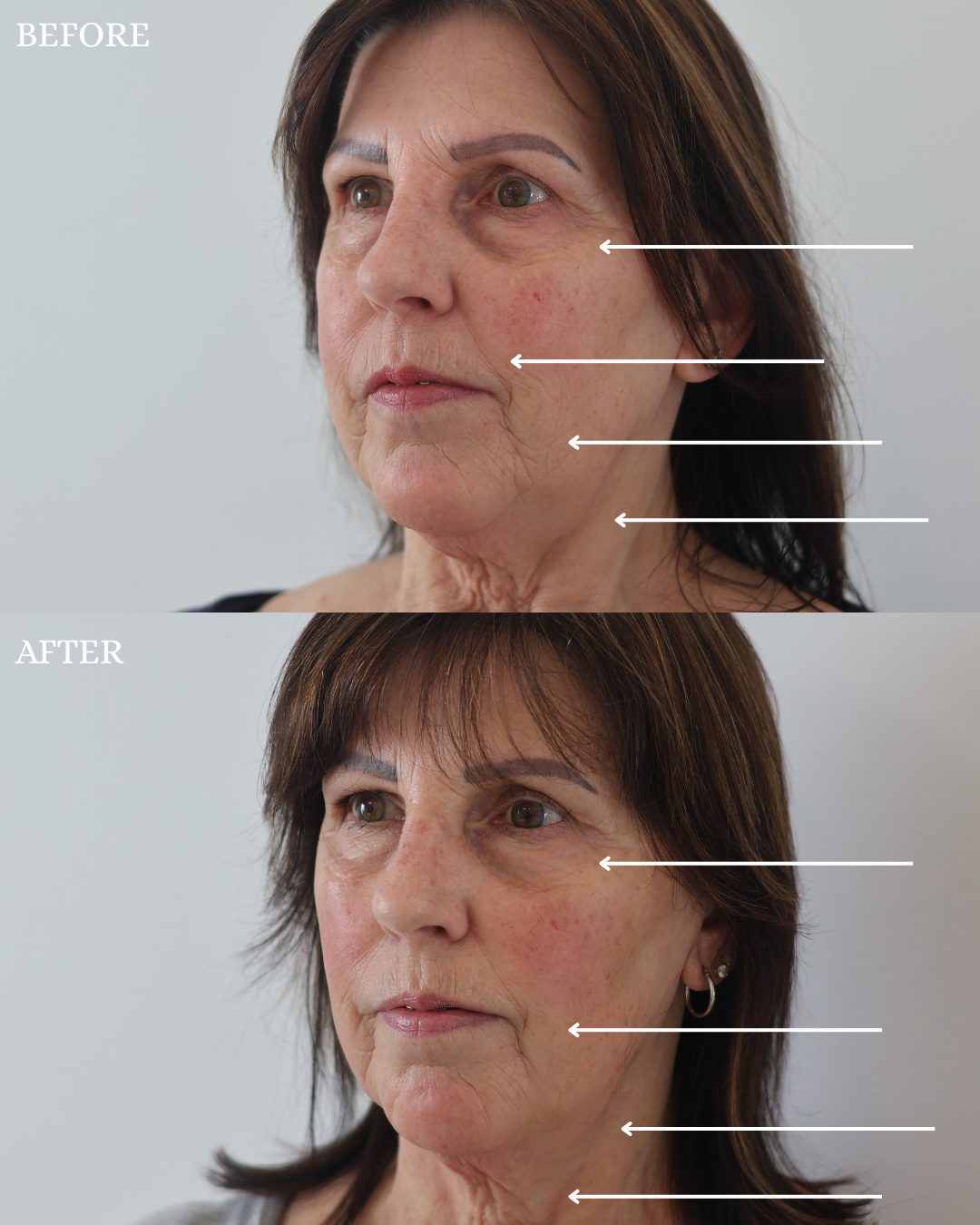 RF Microneedling