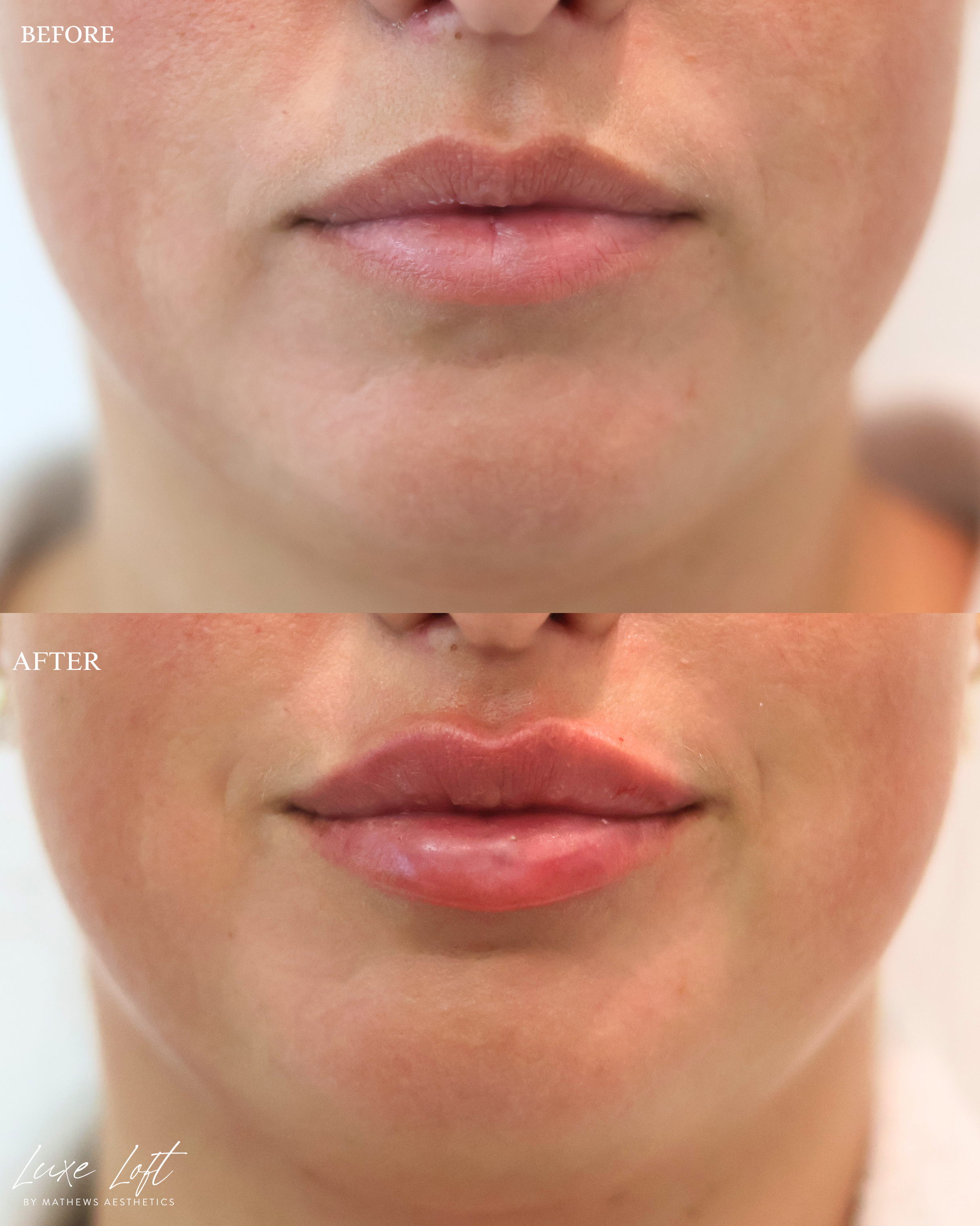Close-up of a person's lips before and after lip enhancement procedure showing fuller, plumper lips in the after image.