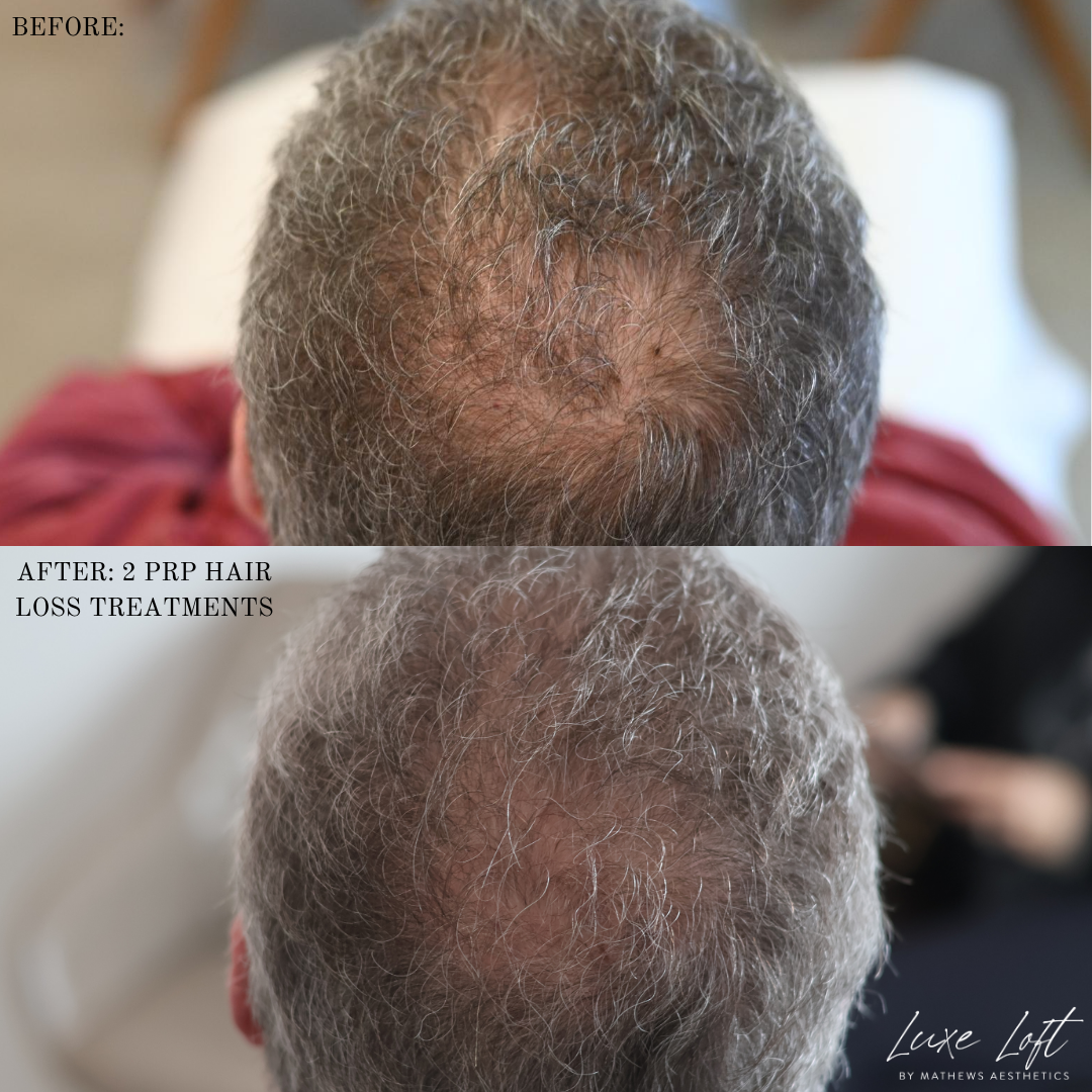 PRP Hair Treatment