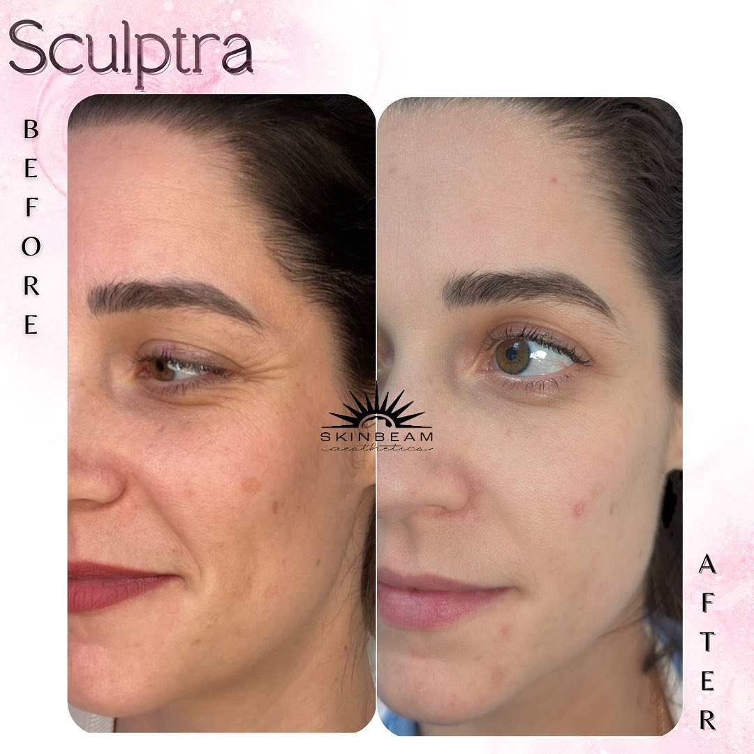 First Sculptra results are in and we are LOVING it!! 😍😍

☀️Sculptra &amp; Dysport: 
3 months post treatment. 

Sculptra firms skin and adds natural volume &amp; glow via your own collagen growth, and Dysport smooths lines - a lovely combination! 

