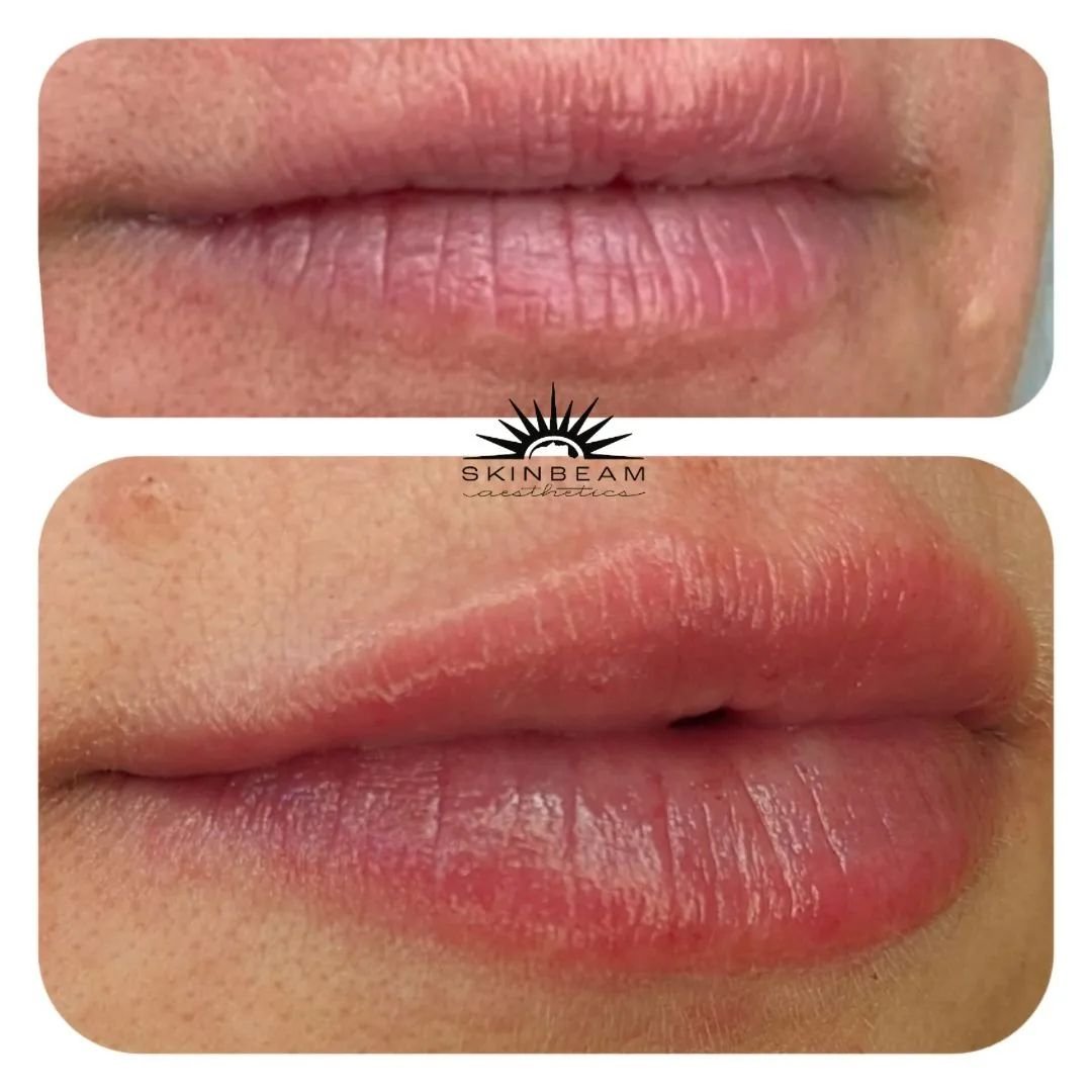 ☀️Natural, hydrated lips 👄 
Lip filler done with 0.75 ml #restylanerefyne 
Numbing cream for comfort 
She loves em! So do we! Thank you for your permission to post! 

#lipfiller #hyaluronic_acid #yourebeaming @galderma #restylanelips #restylane