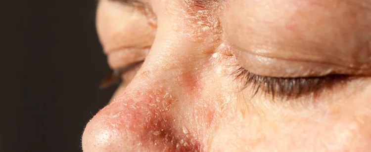 Schuppenflechte Im Gesicht Alnovat Hilft Alnovat Stark Bei Psoriasis