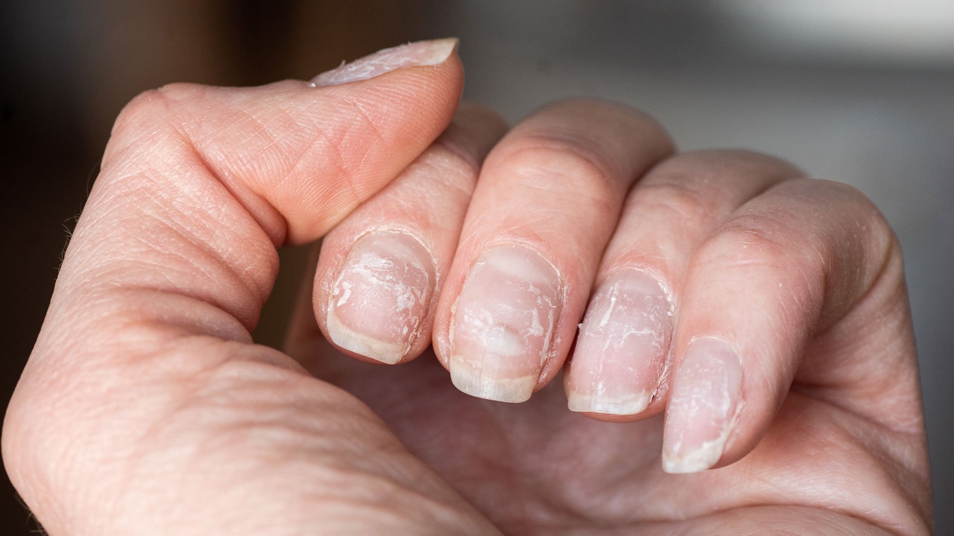 Treatment for Nail Psoriasis: Topicals, Injections, Lasers