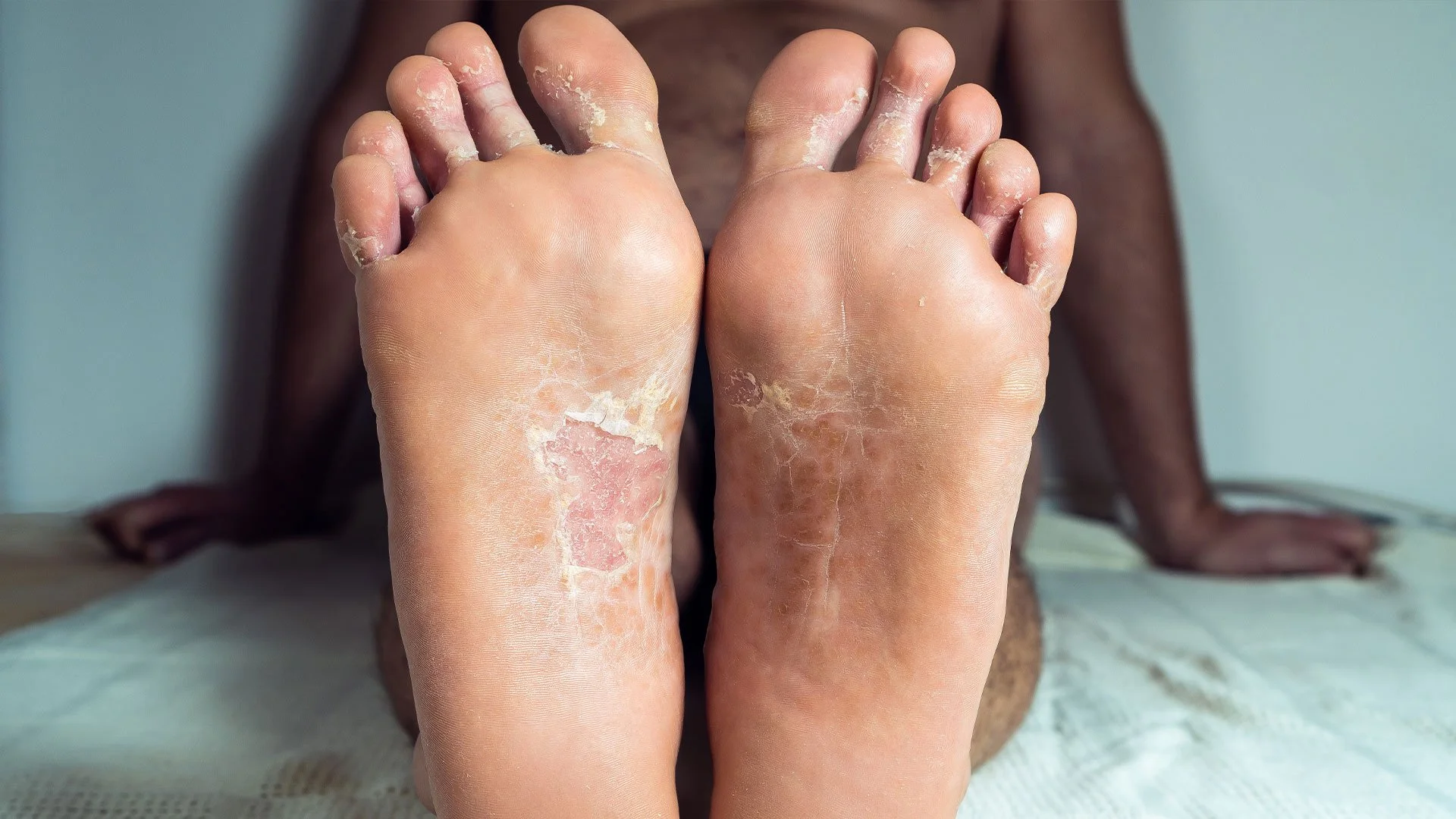 Schuppenflechte an den Füßen — Alnovat Stark bei Psoriasis