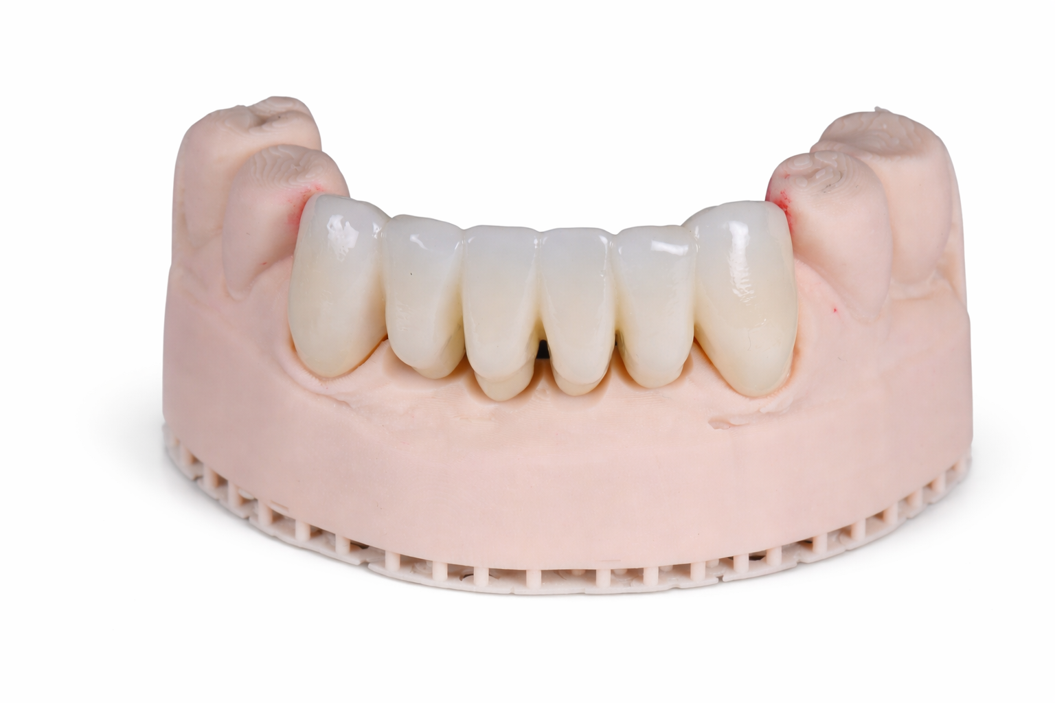 Dental Bridges Queensland Prosthodontics Brisbane Prosthodontics