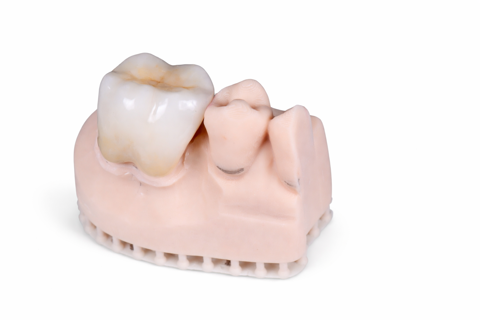 Dental Crowns Queensland Prosthodontics Brisbane Prosthodontics