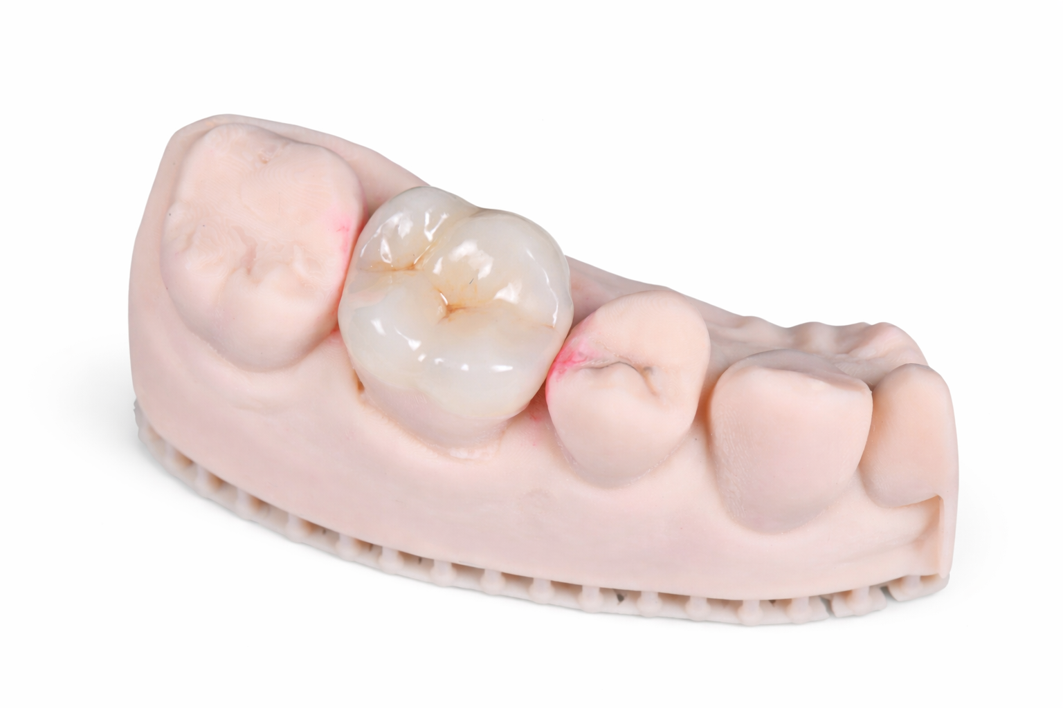 Dental Onlay Queensland Prosthodontics Brisbane Prosthodontics