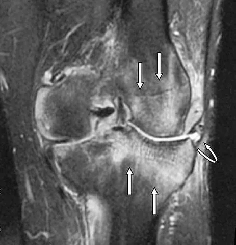 ✨ Edema &oacute;seo: c&oacute;mo podemos ayudarte en Clire Fisioterapia ✨

El edema &oacute;seo es una inflamaci&oacute;n dentro del hueso que suele aparecer tras golpes, sobrecargas, lesiones deportivas o incluso despu&eacute;s de una cirug&iacute;a