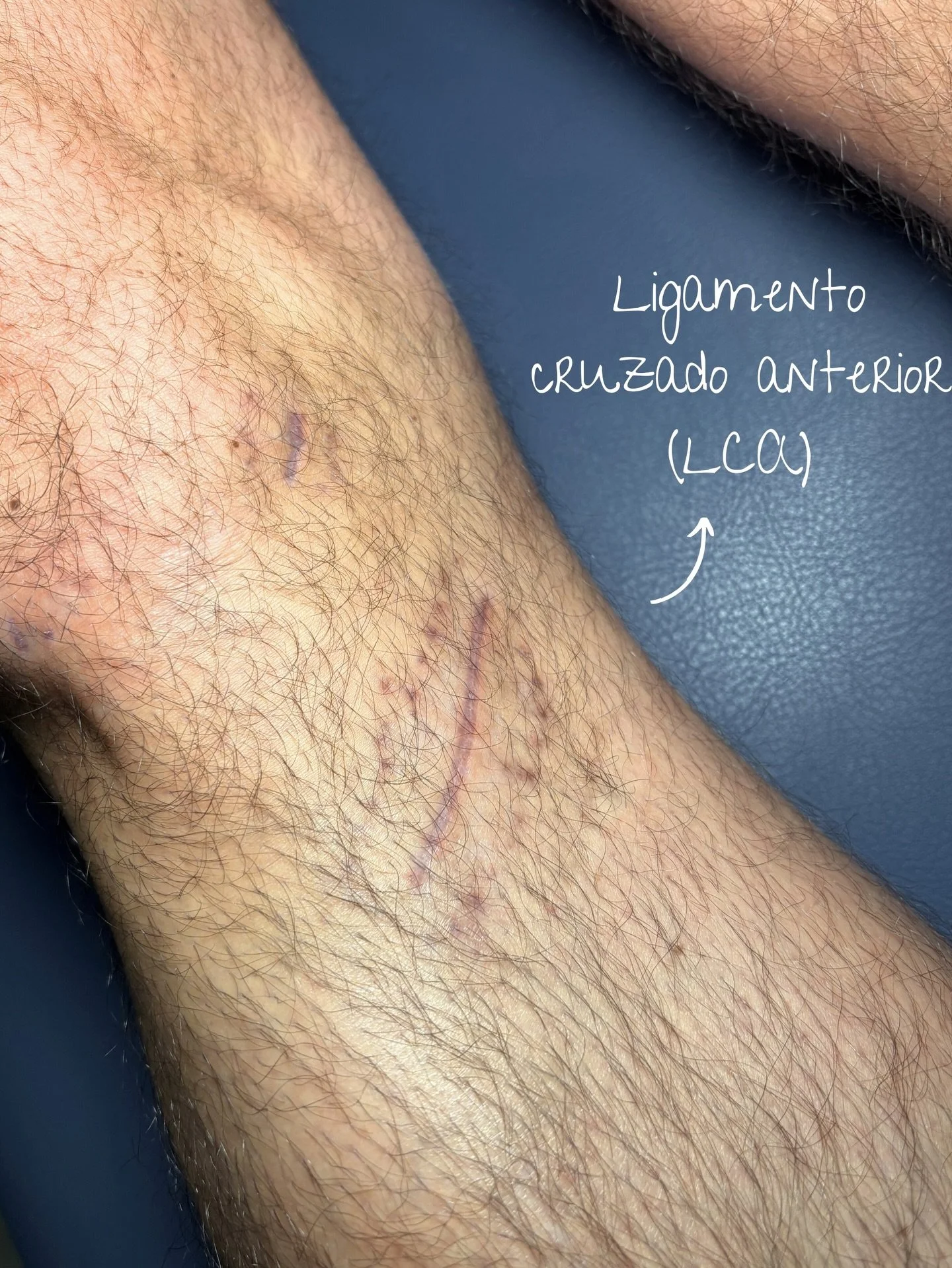 📋 Rehabilitaci&oacute;n de Ligamento Cruzado anterior (LCA)

📌 Un proceso estructurado, progresivo y basado en criterios cl&iacute;nicos.   ✔️ El objetivo es restaurar movilidad, fuerza, control neuromuscular y estabilidad, reduciendo el riesgo de 