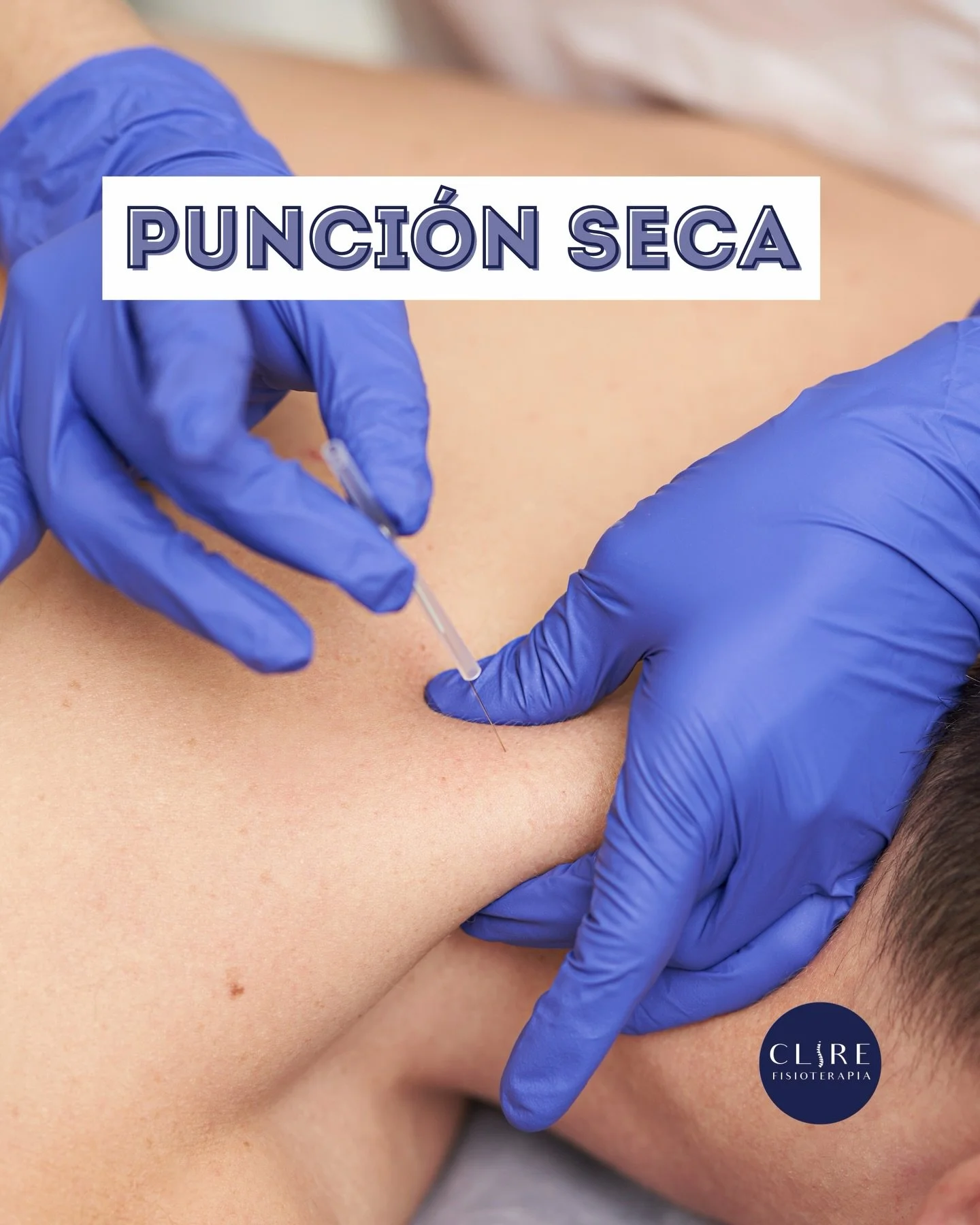 Punci&oacute;n seca 🪡👋🏻

📌 Alivio inmediato del dolor
📌 Aumento de la movilidad y flexibilidad
📌 Recuperaci&oacute;n r&aacute;pida y profunda

Es una t&eacute;cnica segura, que generalmente ofrece resultados notables desde la primera sesi&oacut